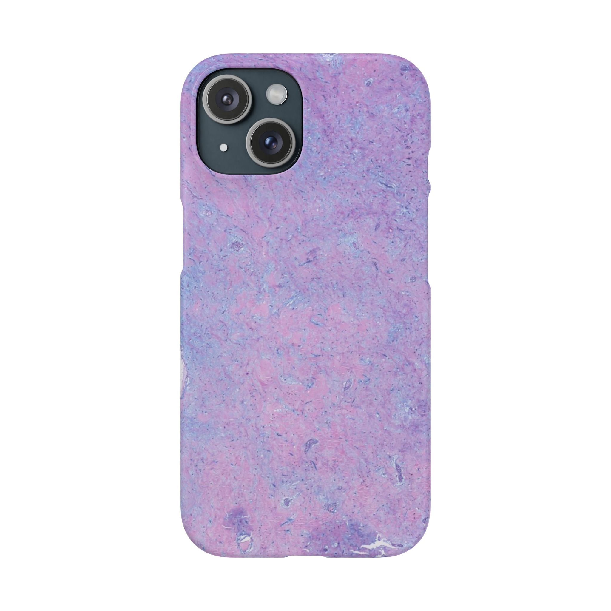Slim Case Arterielles Myxom