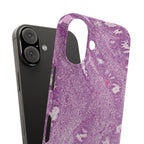 Slim Case Endometrium
