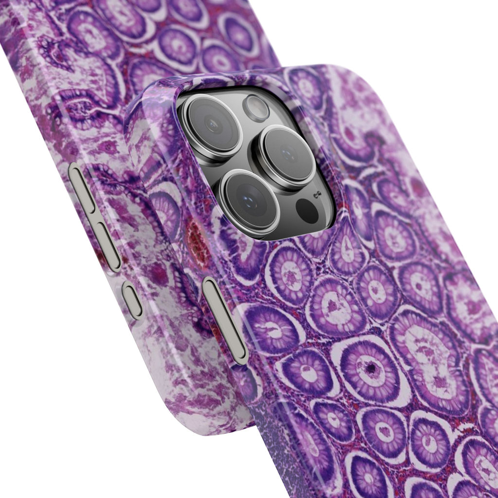 Slim Case Peutz-Jeghers Polyp
