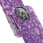 Slim Case Peutz-Jeghers Polyp