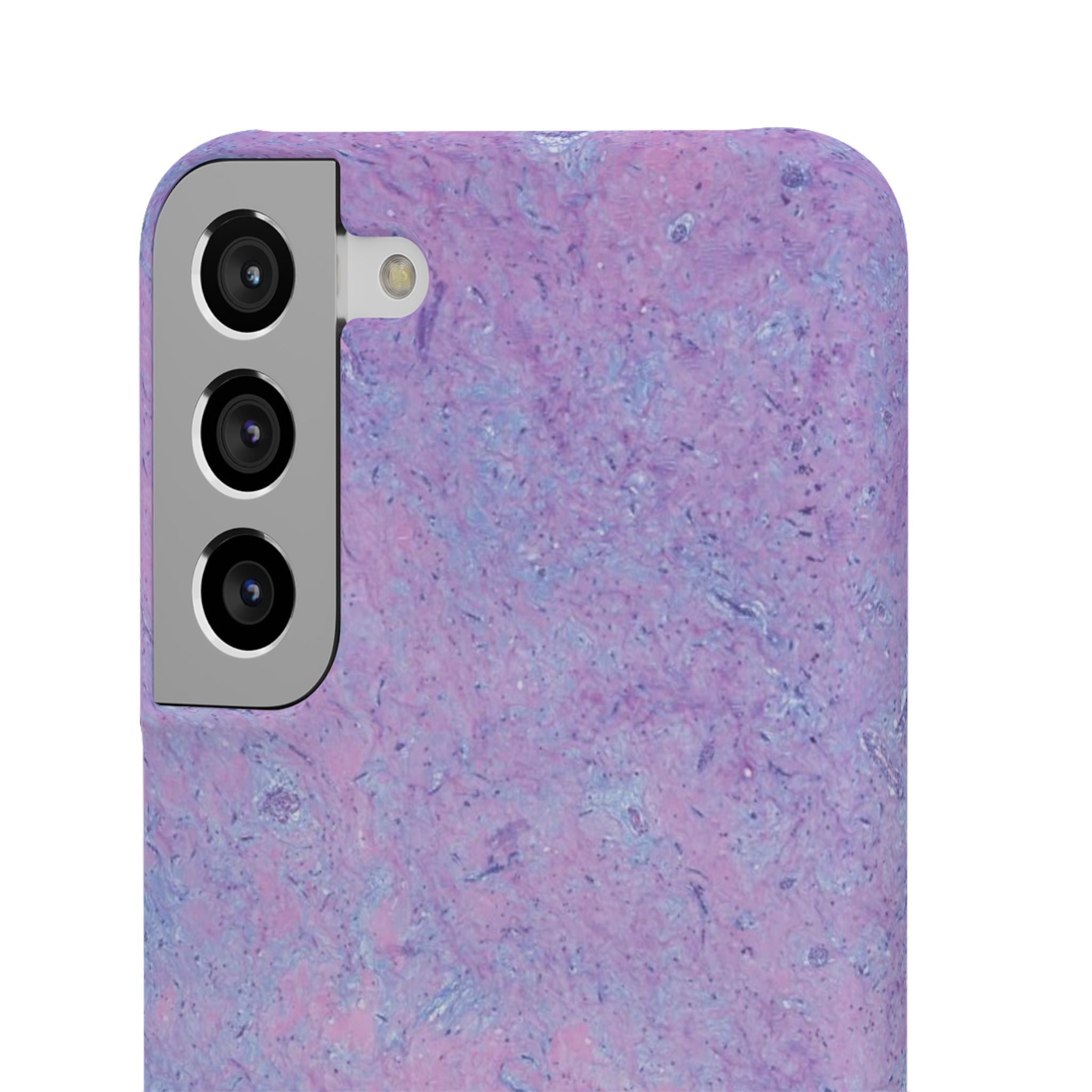 Slim Case Arterielles Myxom