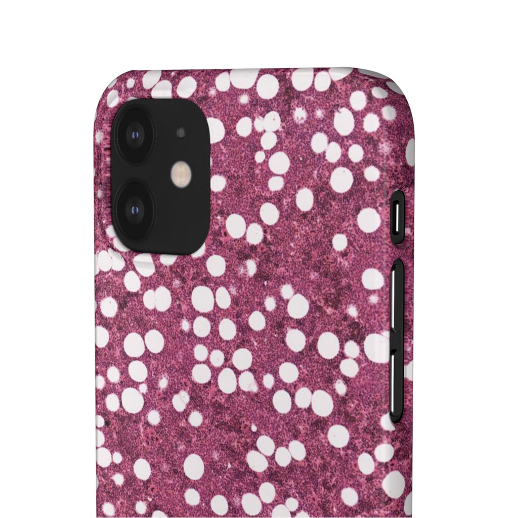 Slim Case Myelolipom