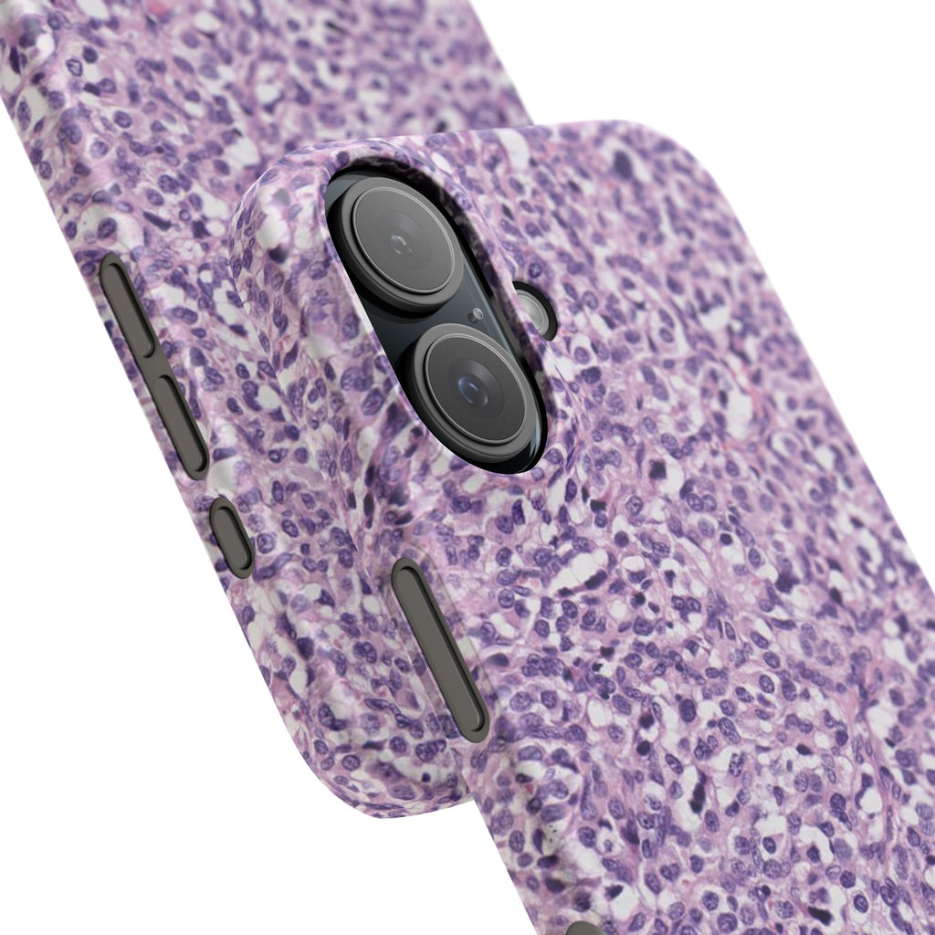 Slim Case Paraganglion