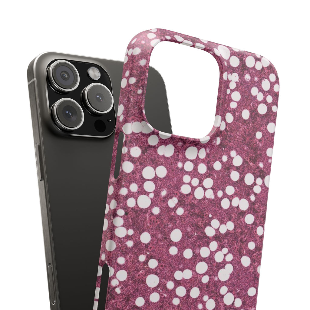 Slim Case Myelolipom