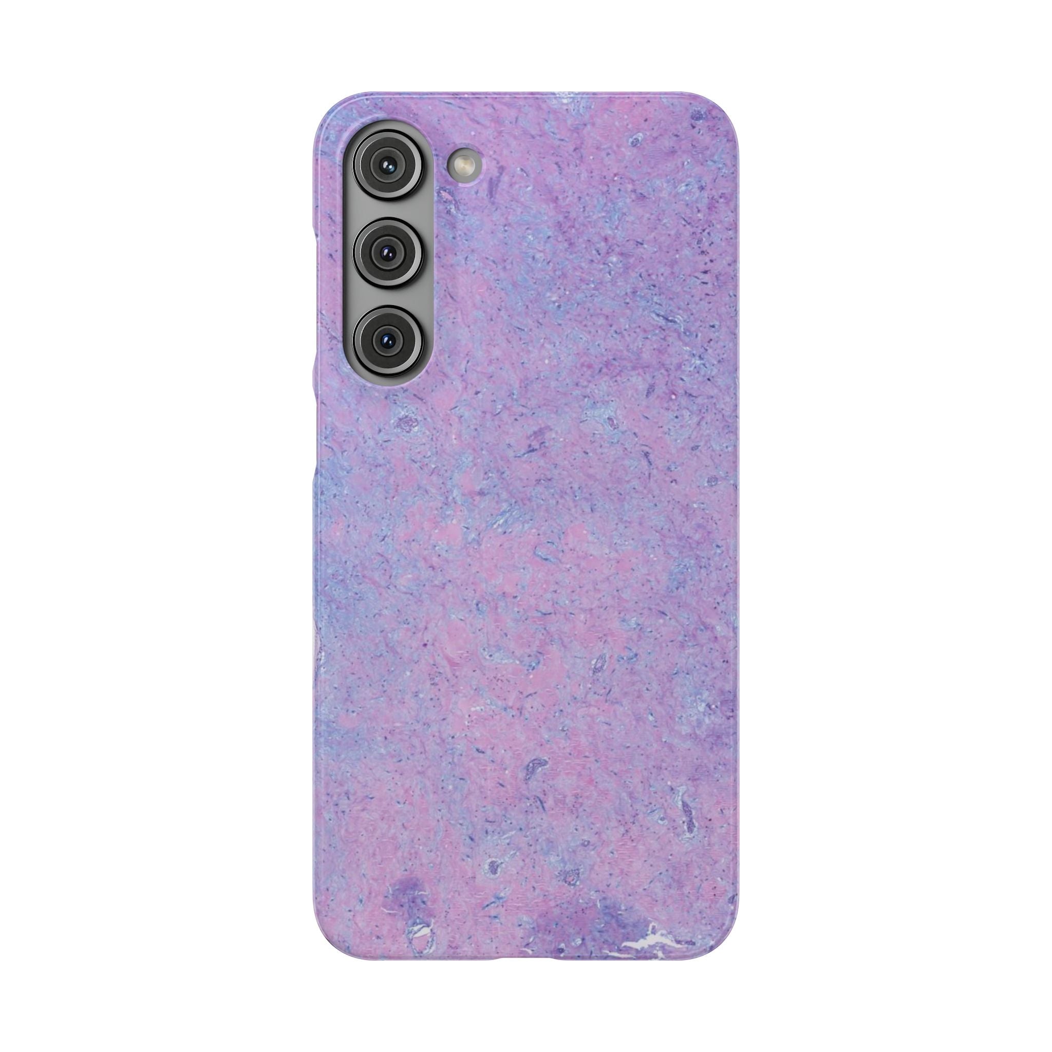 Slim Case Arterielles Myxom