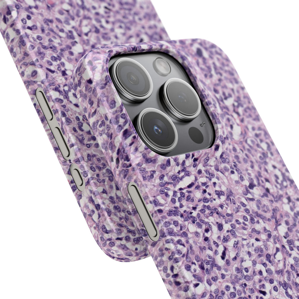 Slim Case Paraganglion