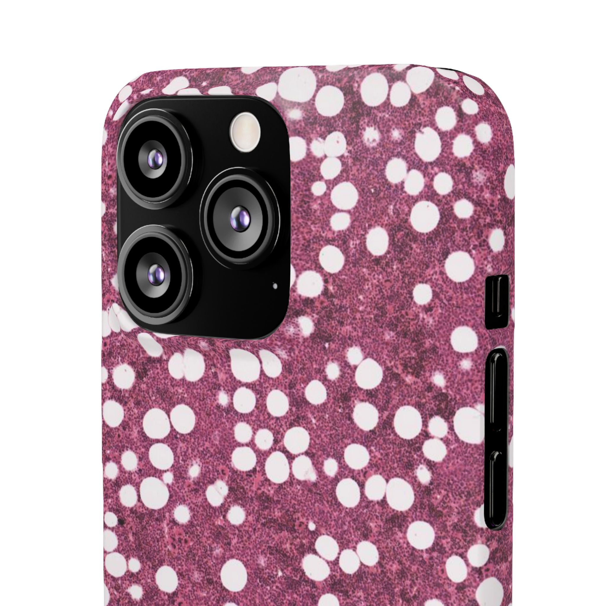 Slim Case Myelolipom