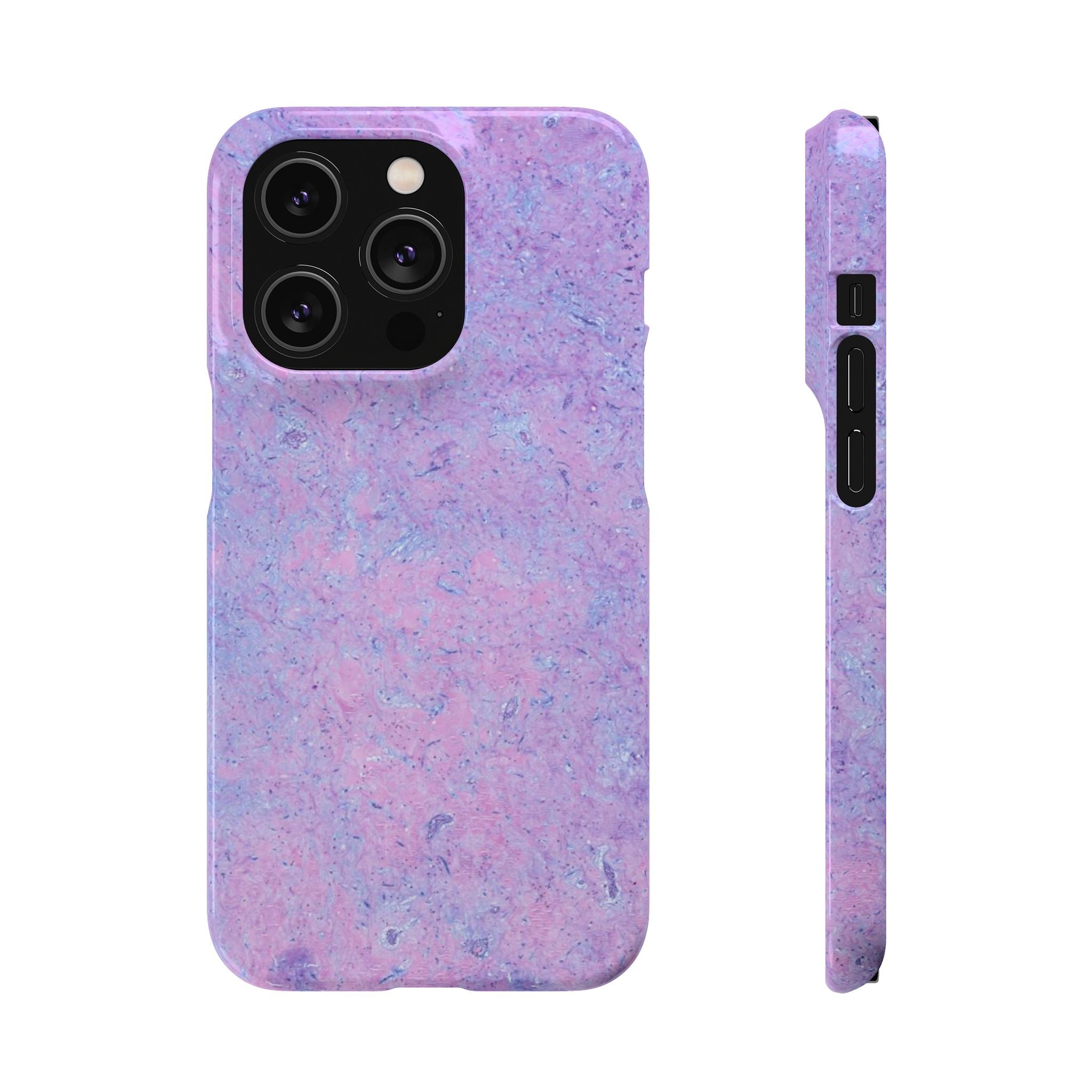 Slim Case Arterielles Myxom