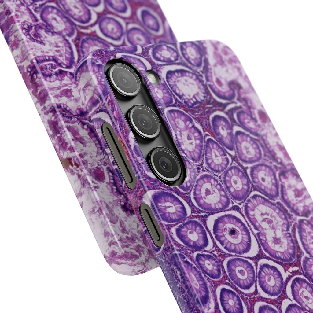 Slim Case Peutz-Jeghers Polyp