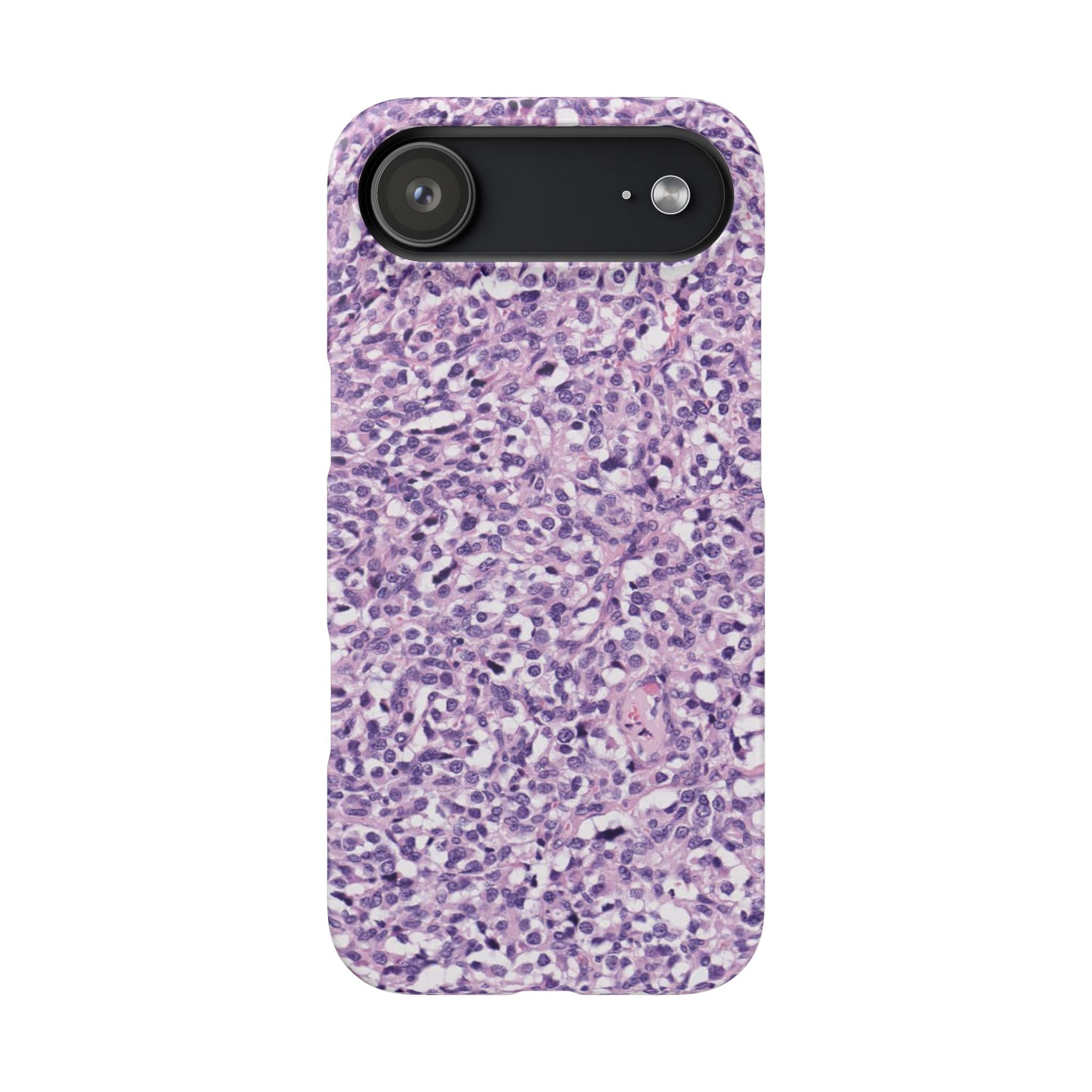 Slim Case Paraganglion