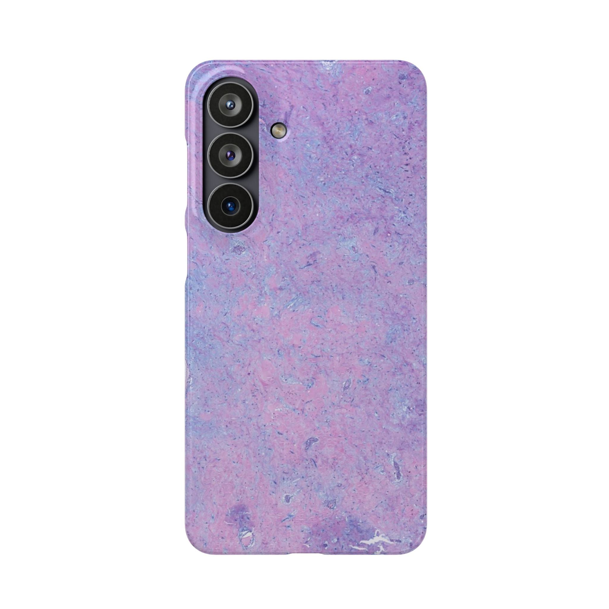 Slim Case Arterielles Myxom