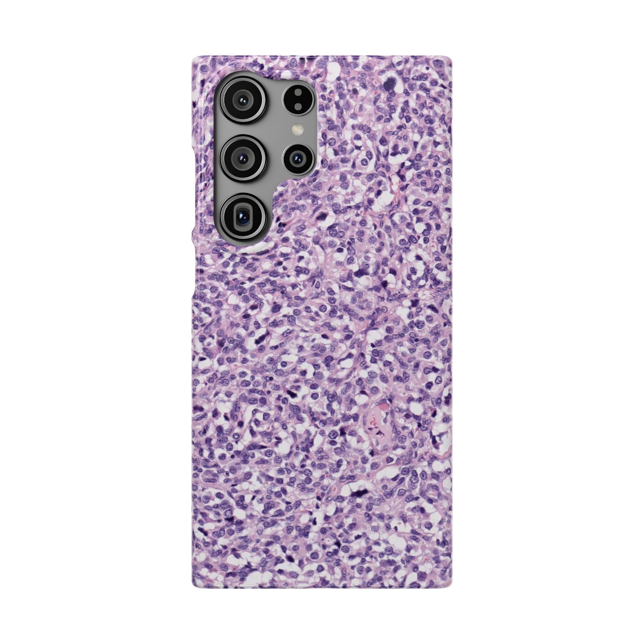Slim Case Paraganglion