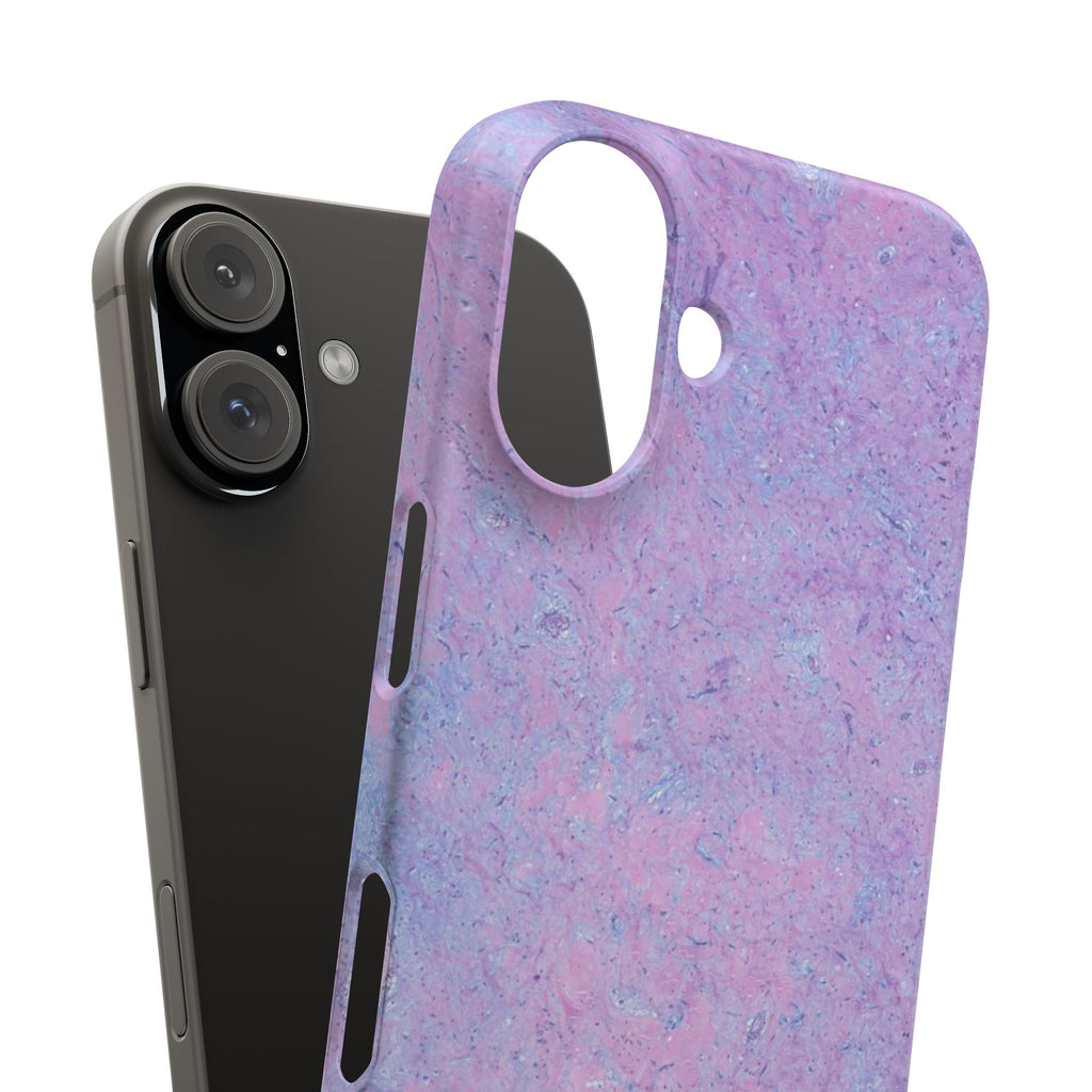 Slim Case Arterielles Myxom