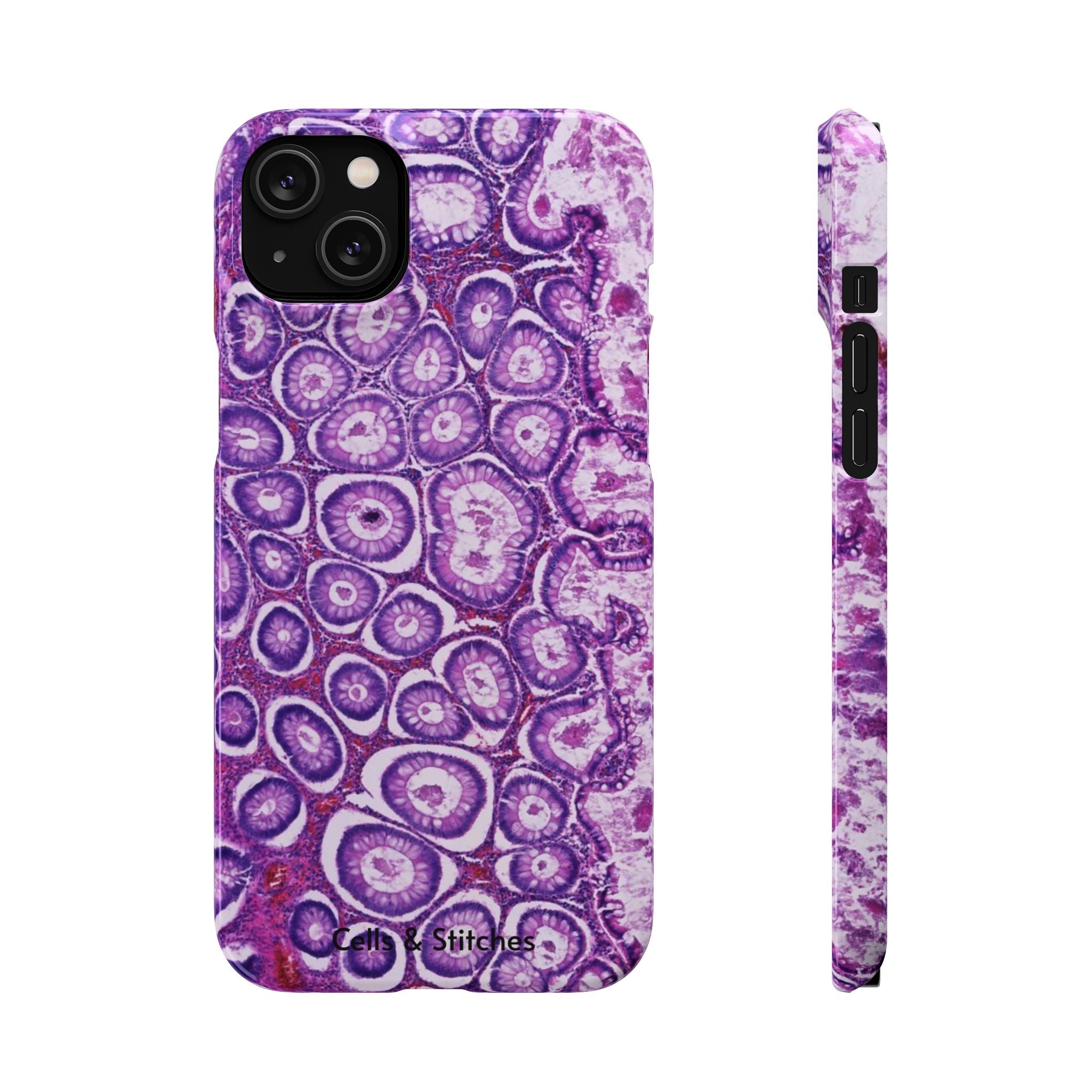 Slim Case Peutz-Jeghers Polyp
