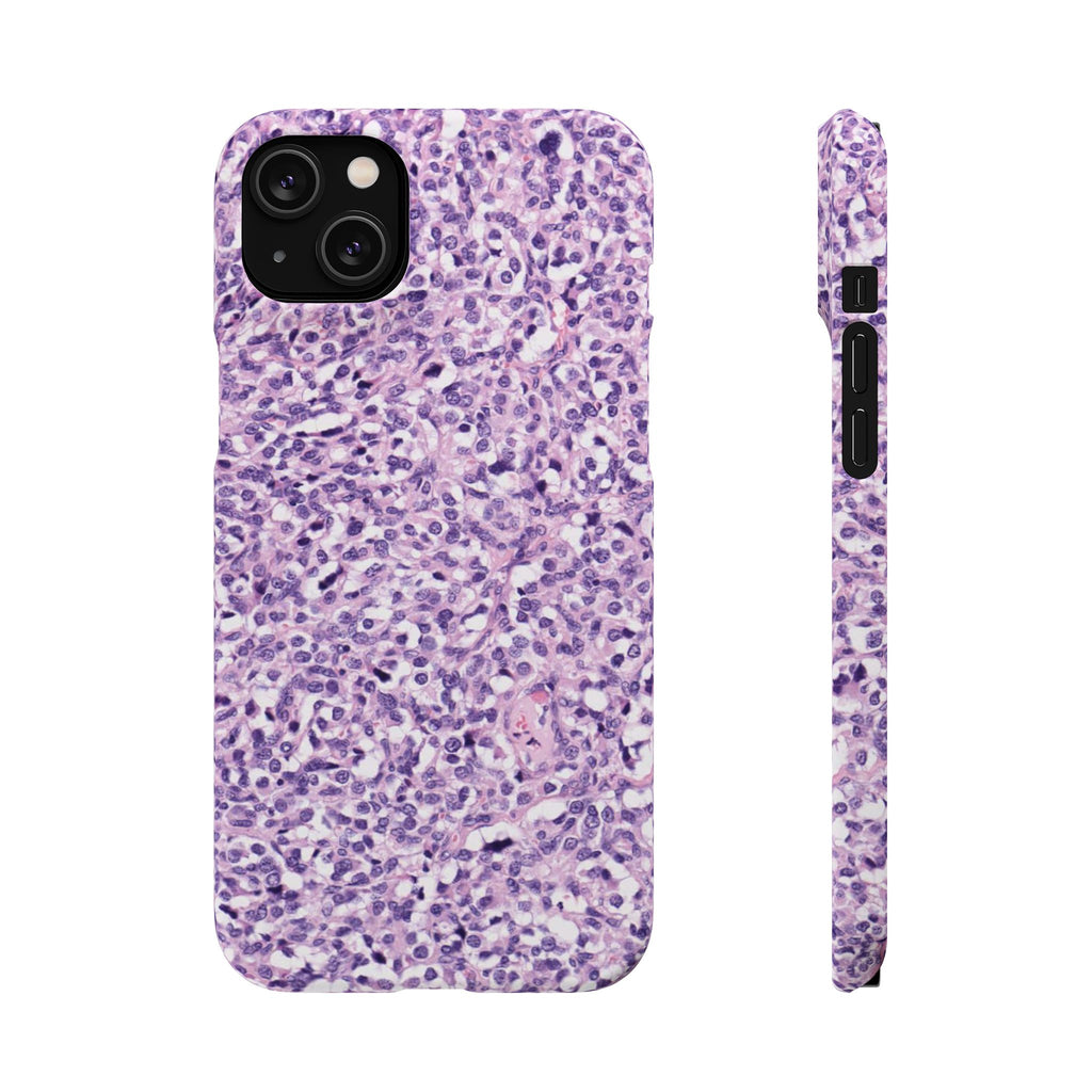 Slim Case Paraganglion