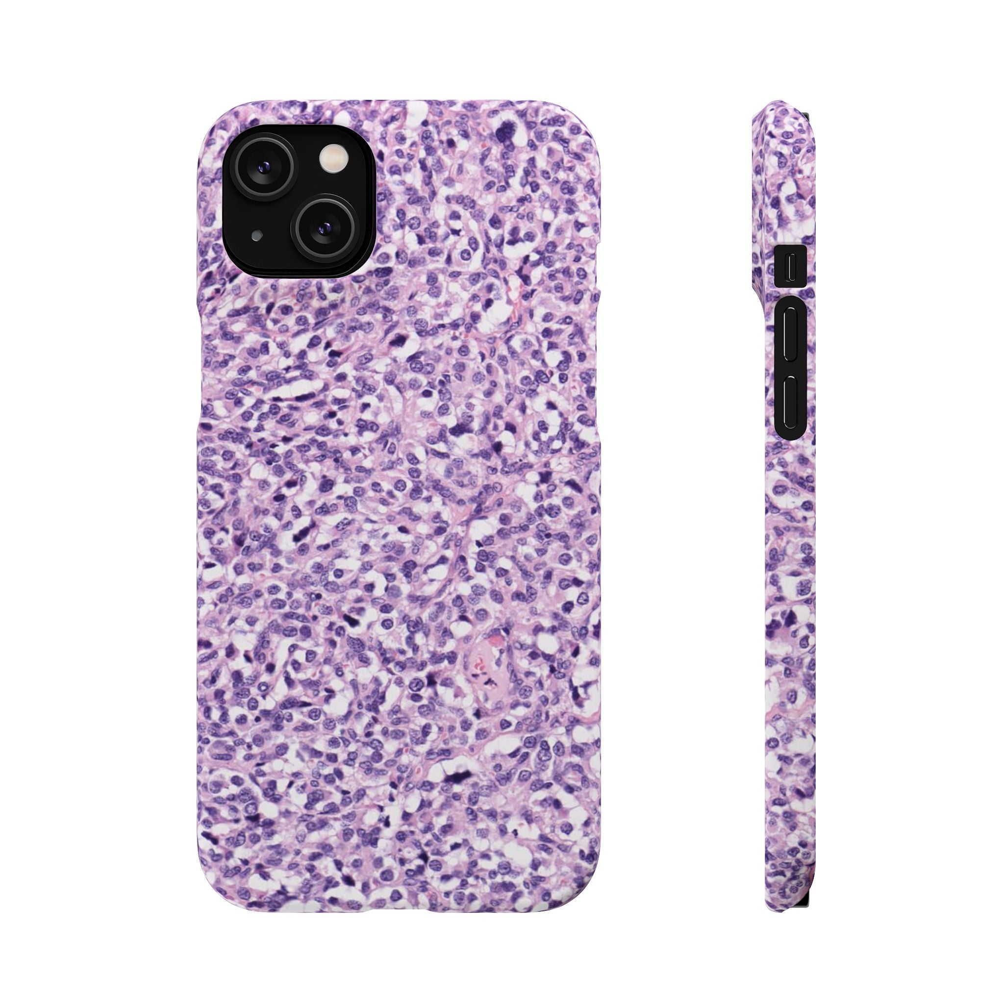 Slim Case Paraganglion