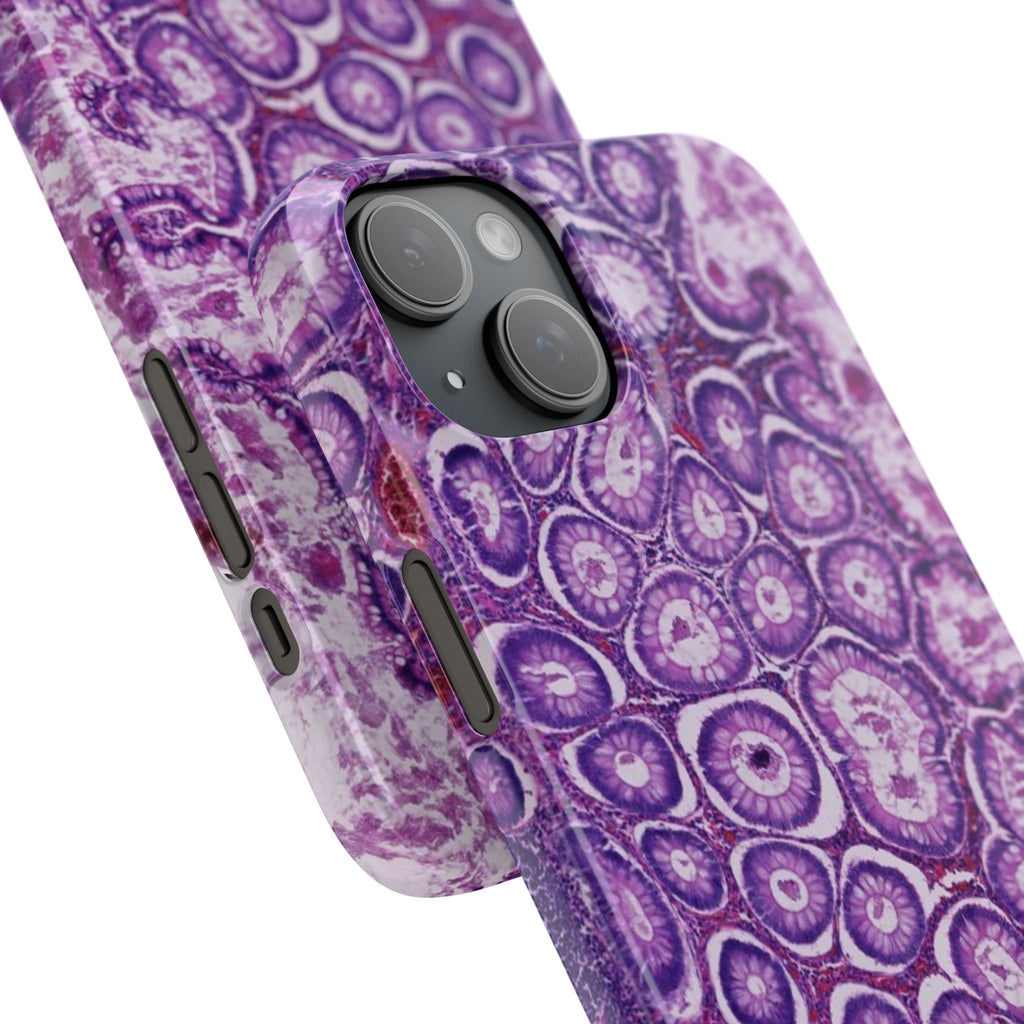 Slim Case Peutz-Jeghers Polyp