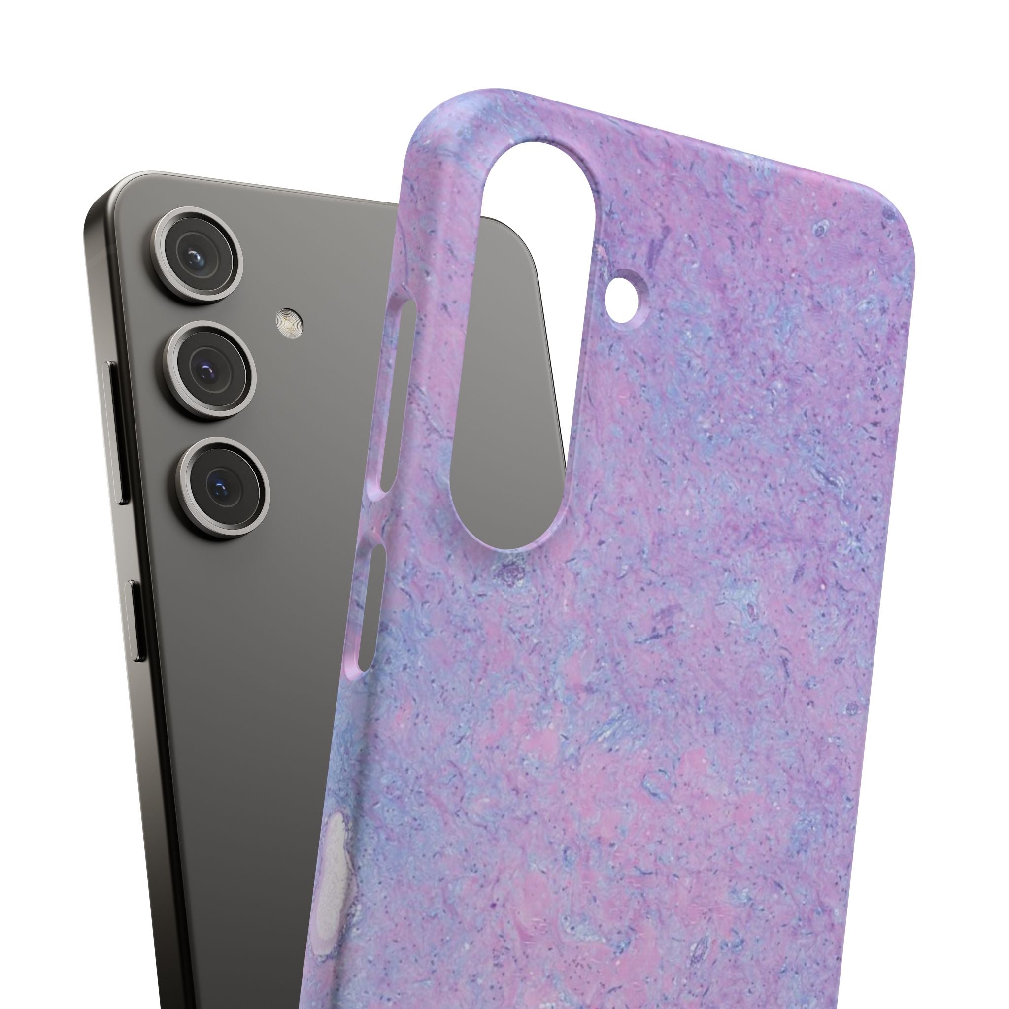 Slim Case Arterielles Myxom