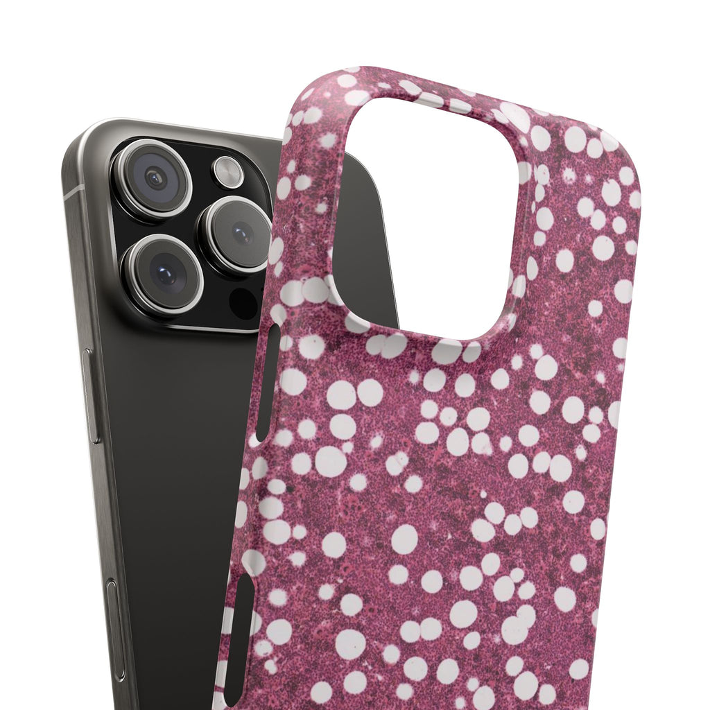 Slim Case Myelolipom