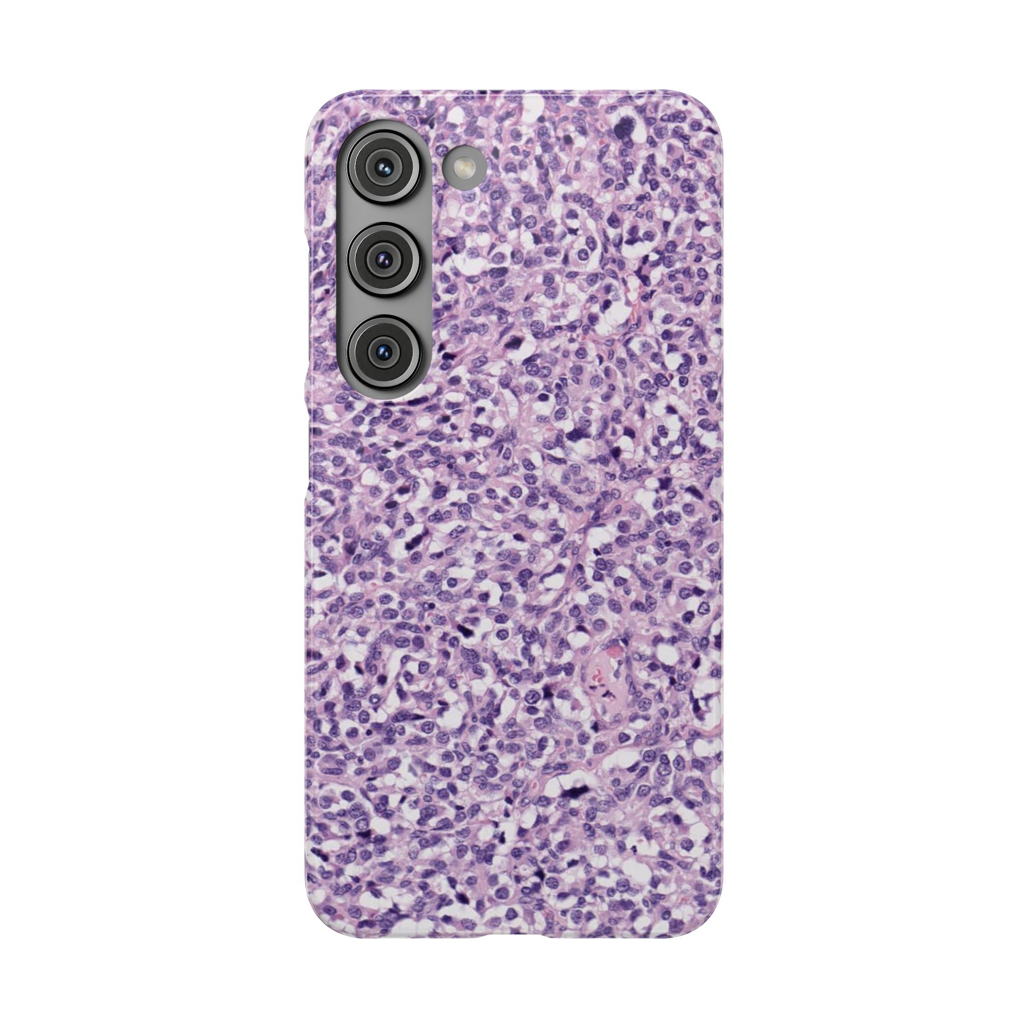 Slim Case Paraganglion