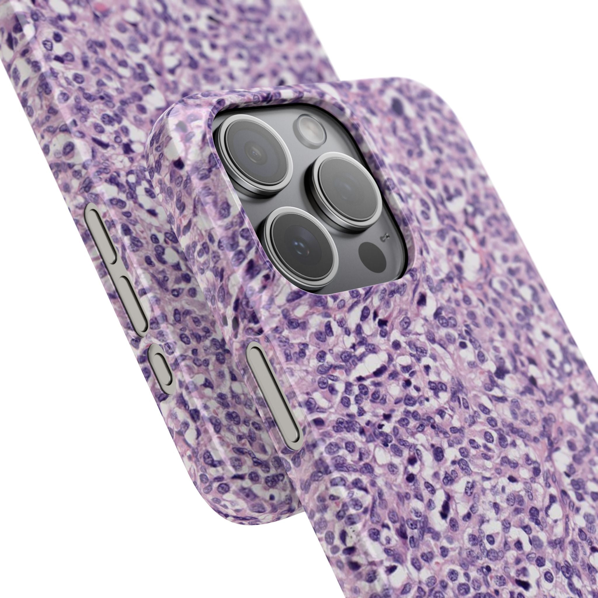 Slim Case Paraganglion