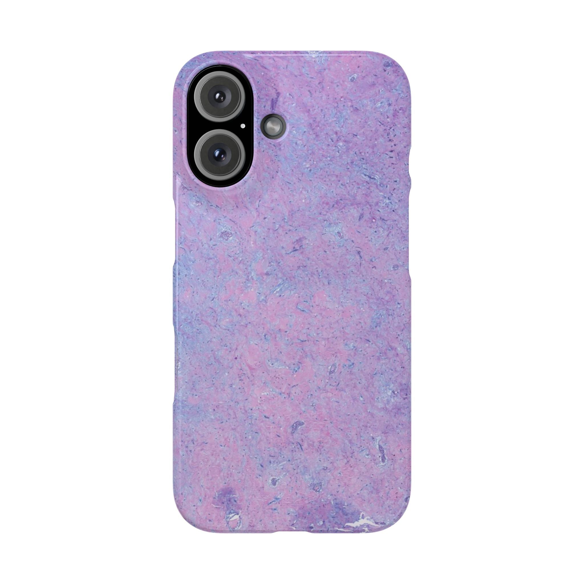 Slim Case Arterielles Myxom