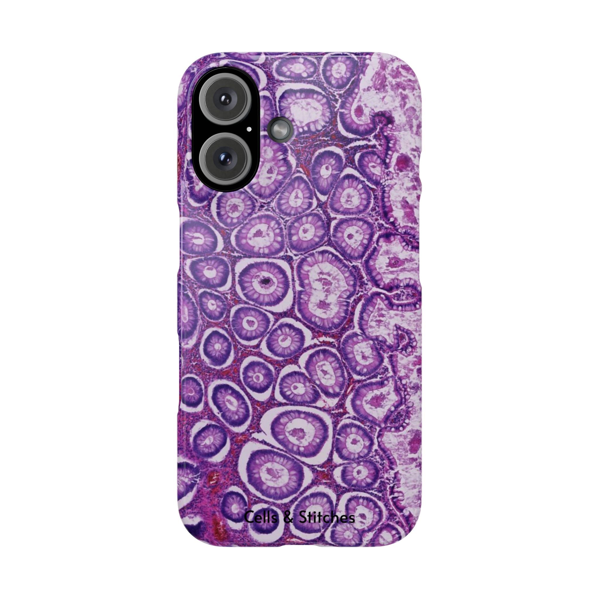Slim Case Peutz-Jeghers Polyp