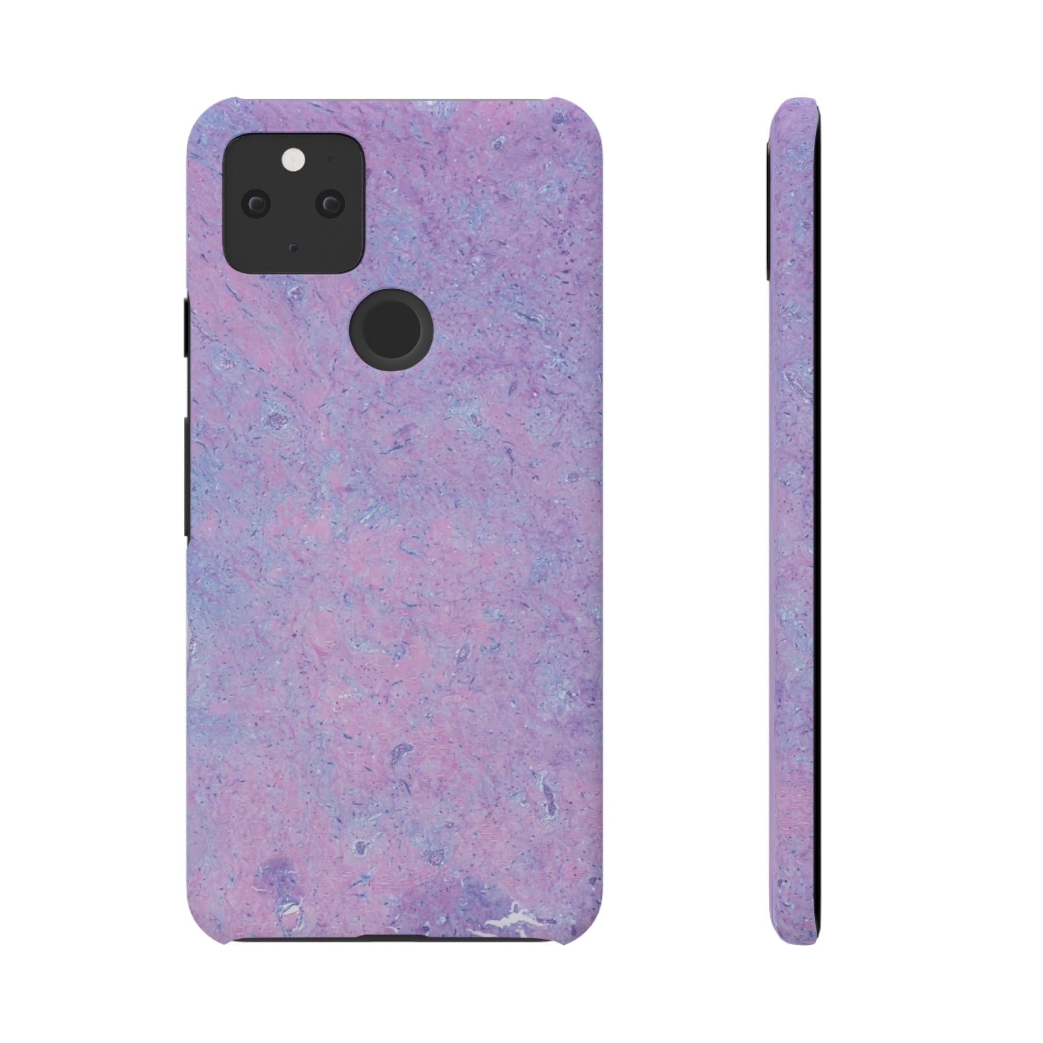Slim Case Arterielles Myxom