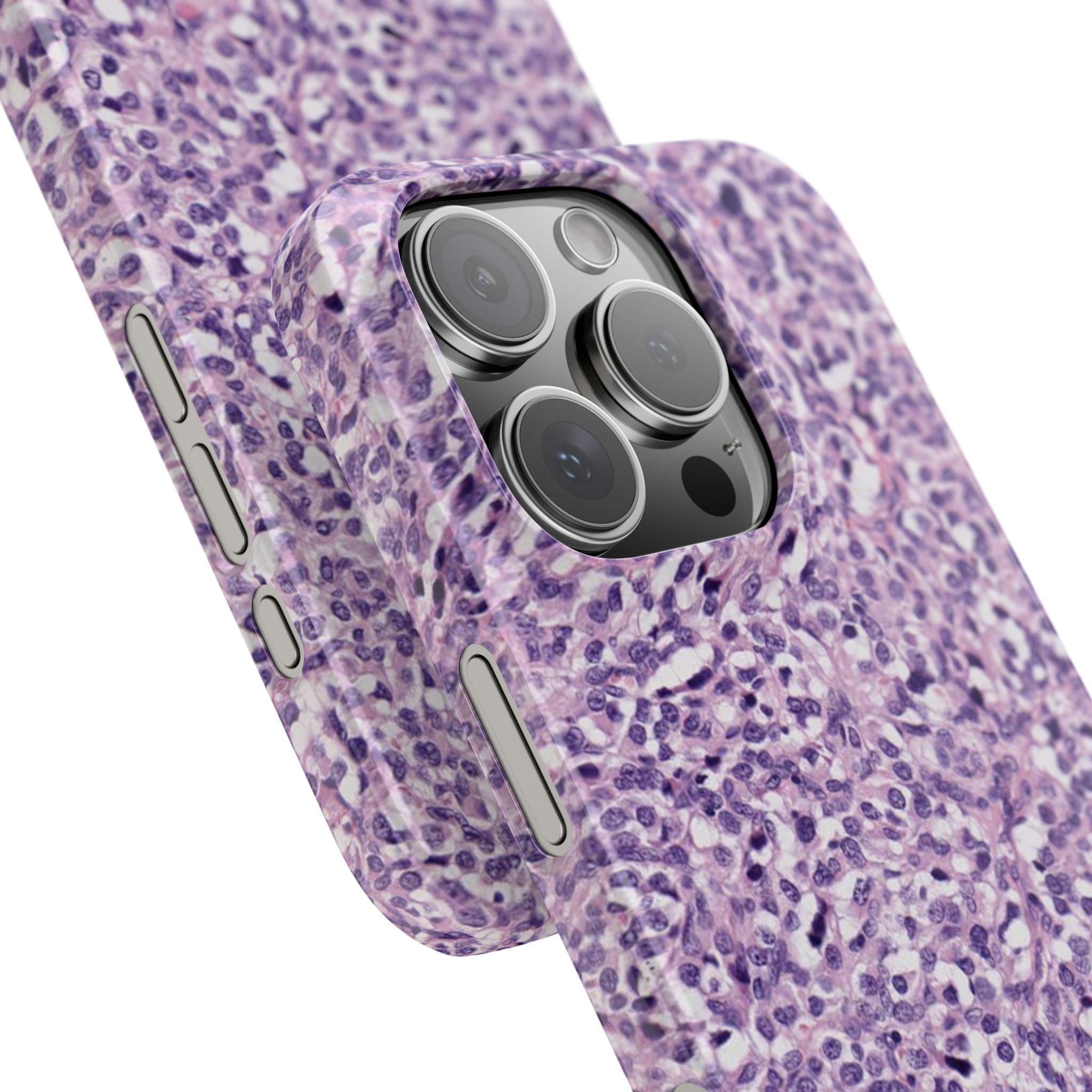 Slim Case Paraganglion
