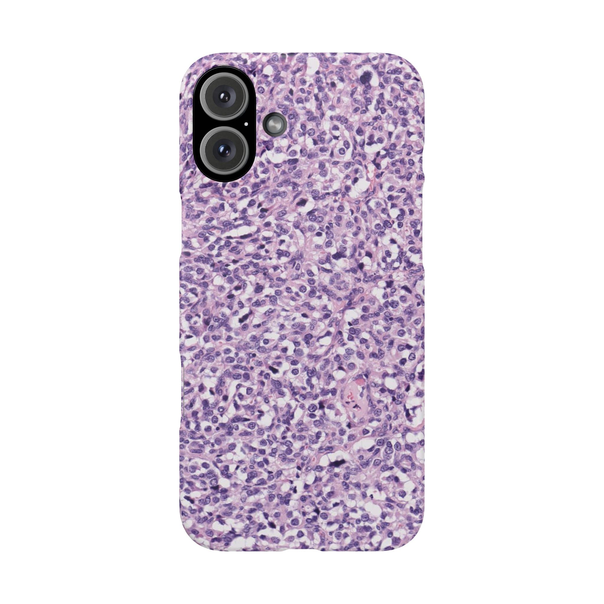 Slim Case Paraganglion