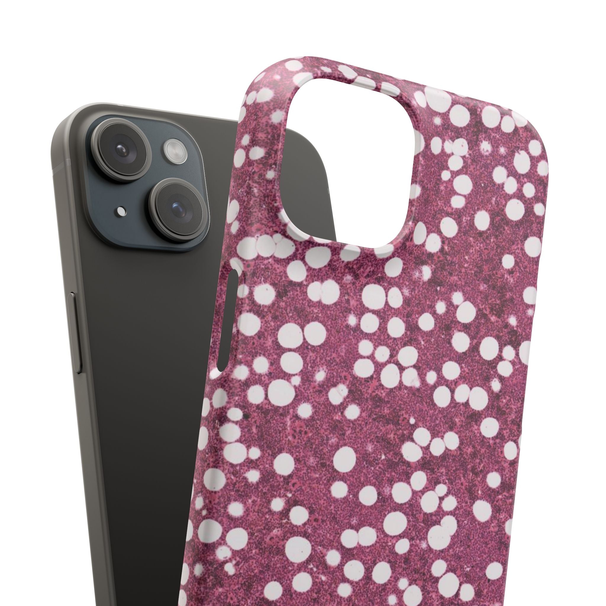 Slim Case Myelolipom