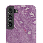 Slim Case Endometrium