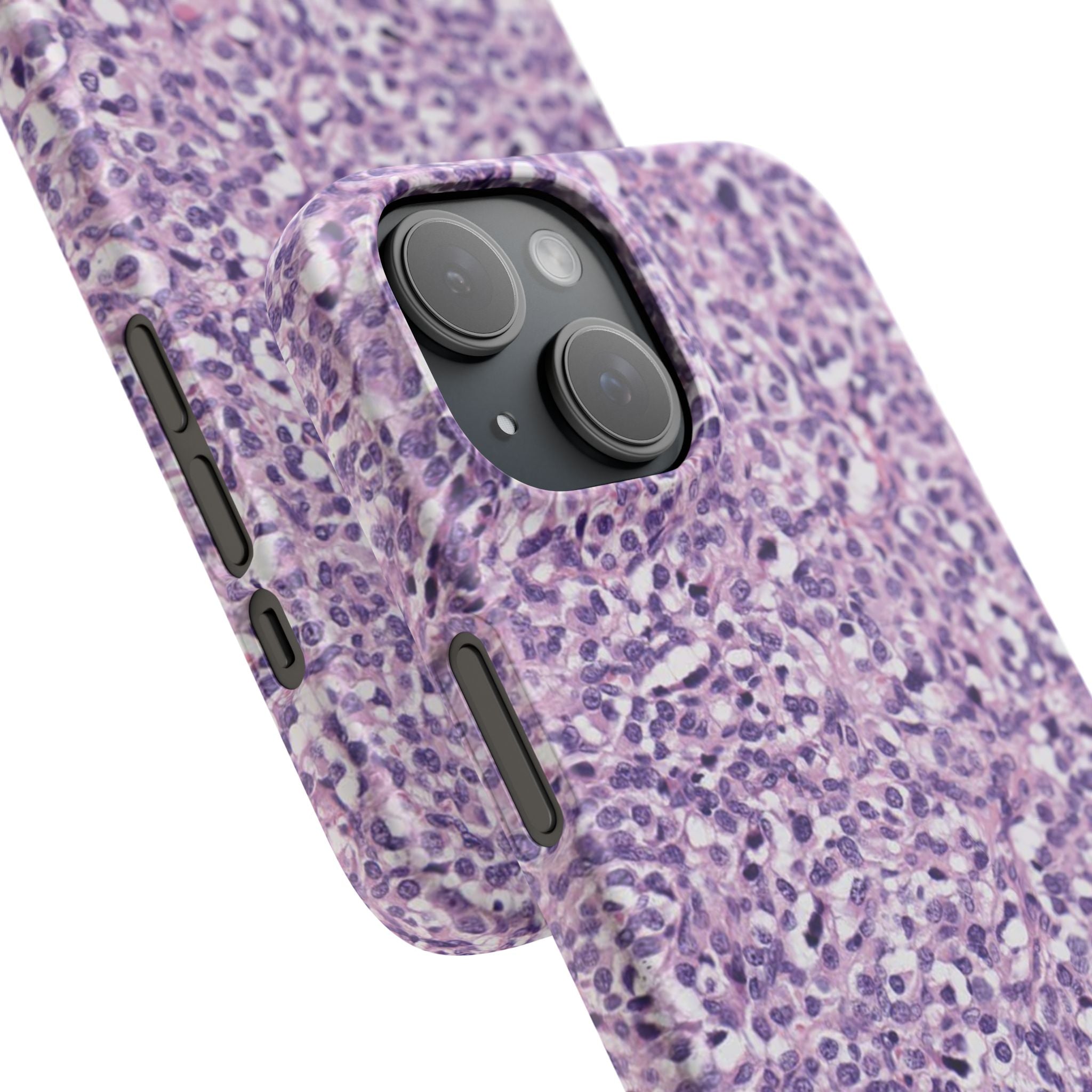 Slim Case Paraganglion