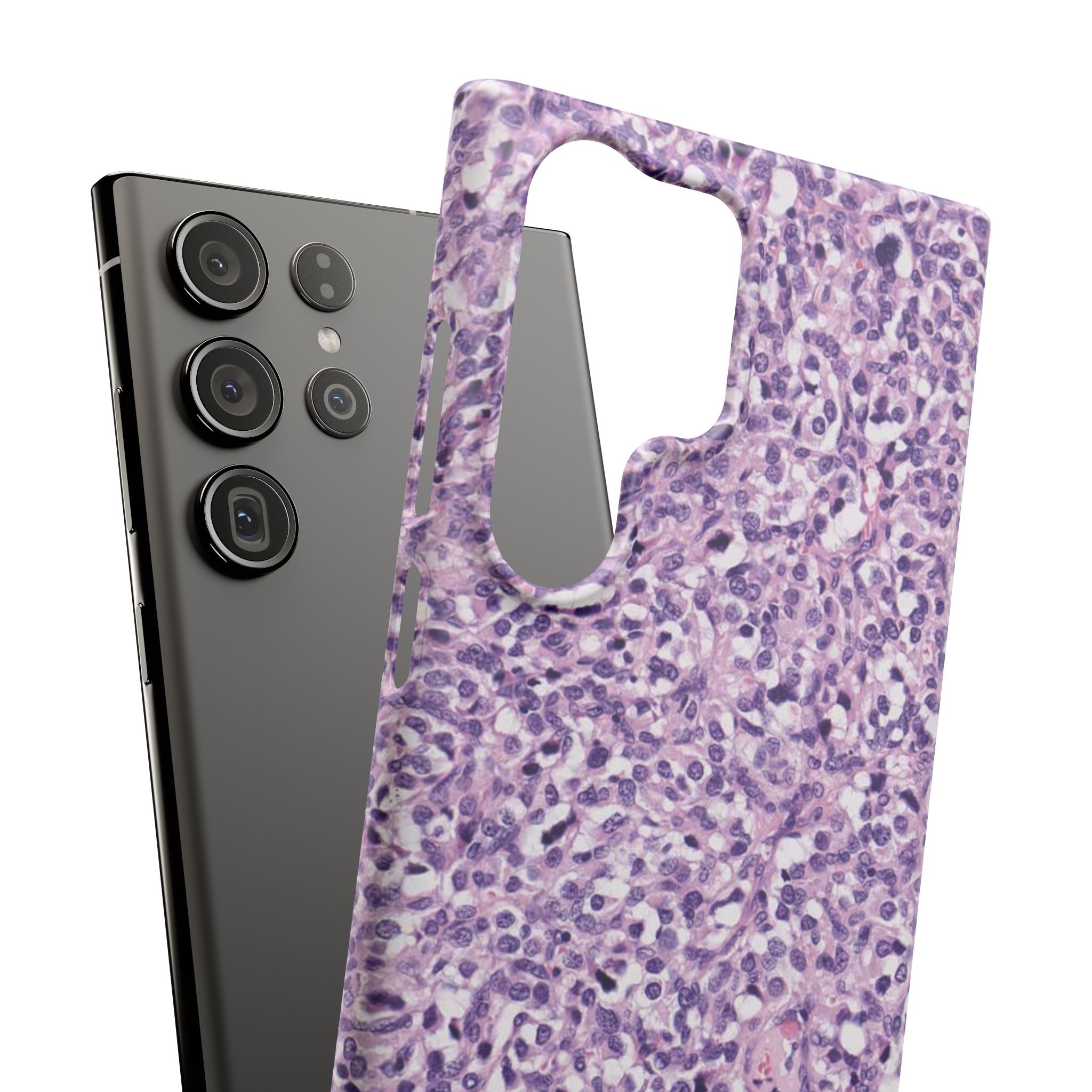 Slim Case Paraganglion