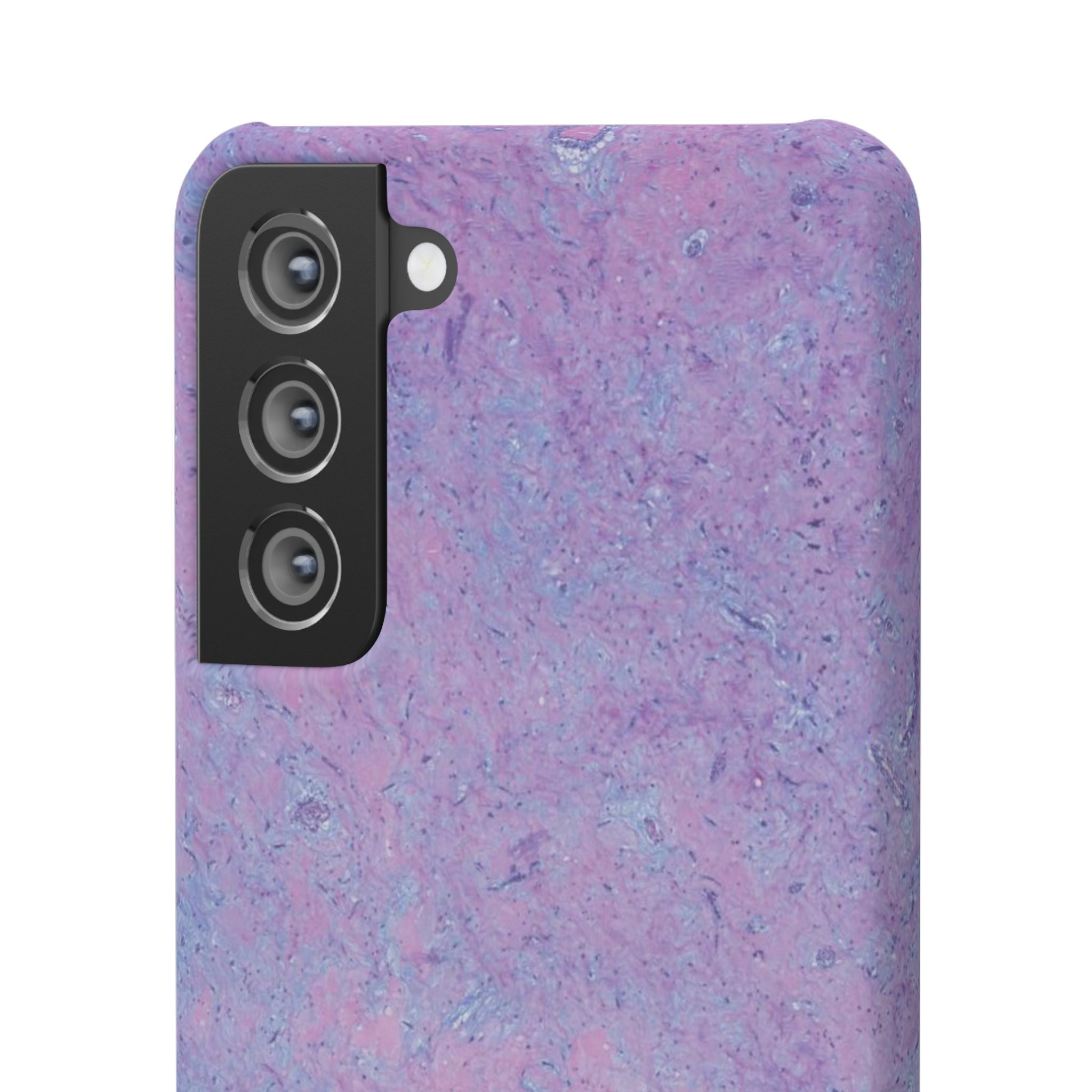 Slim Case Arterielles Myxom
