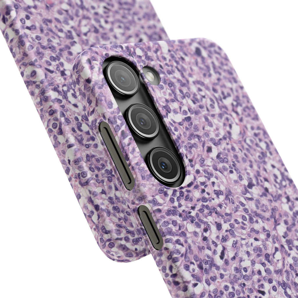Slim Case Paraganglion