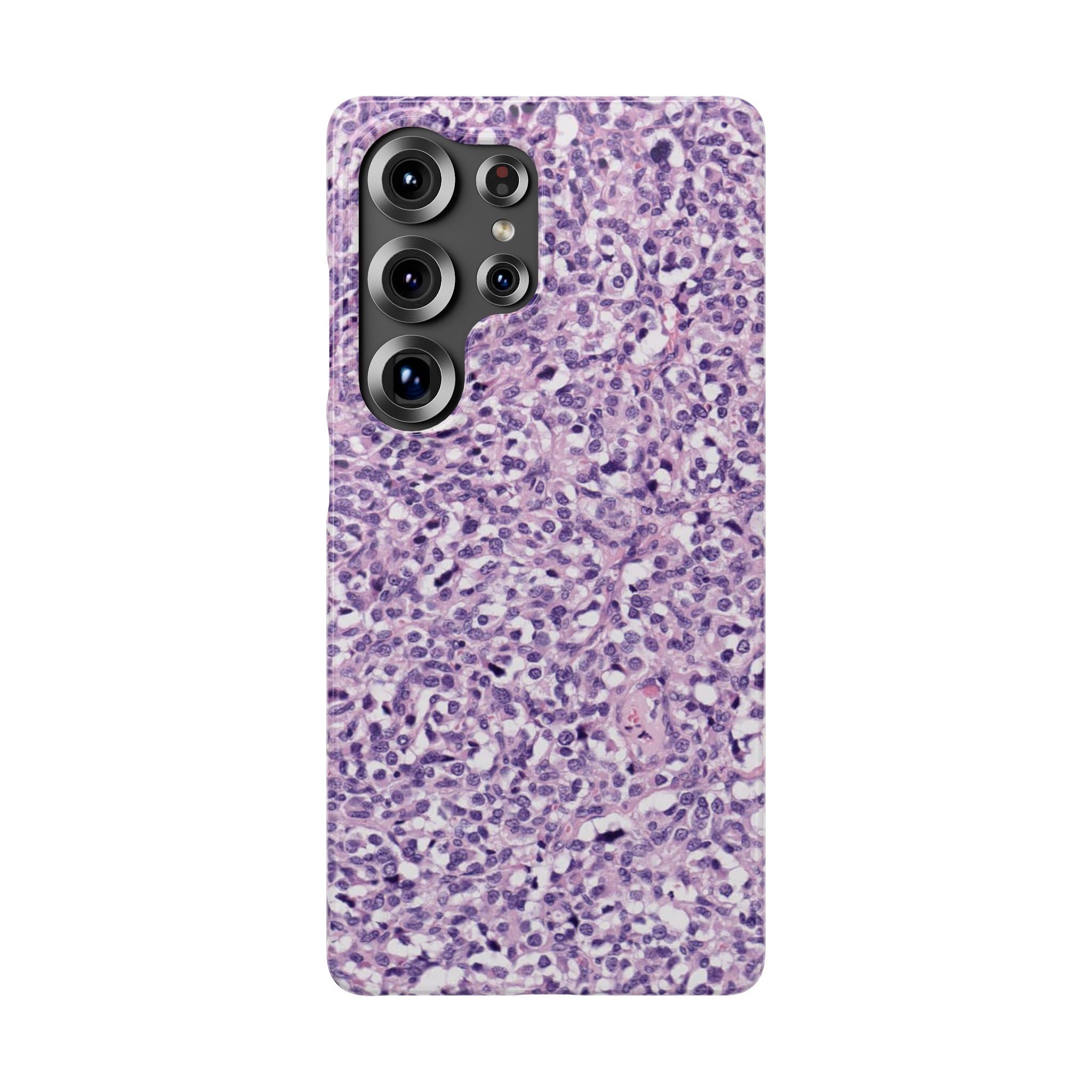Slim Case Paraganglion