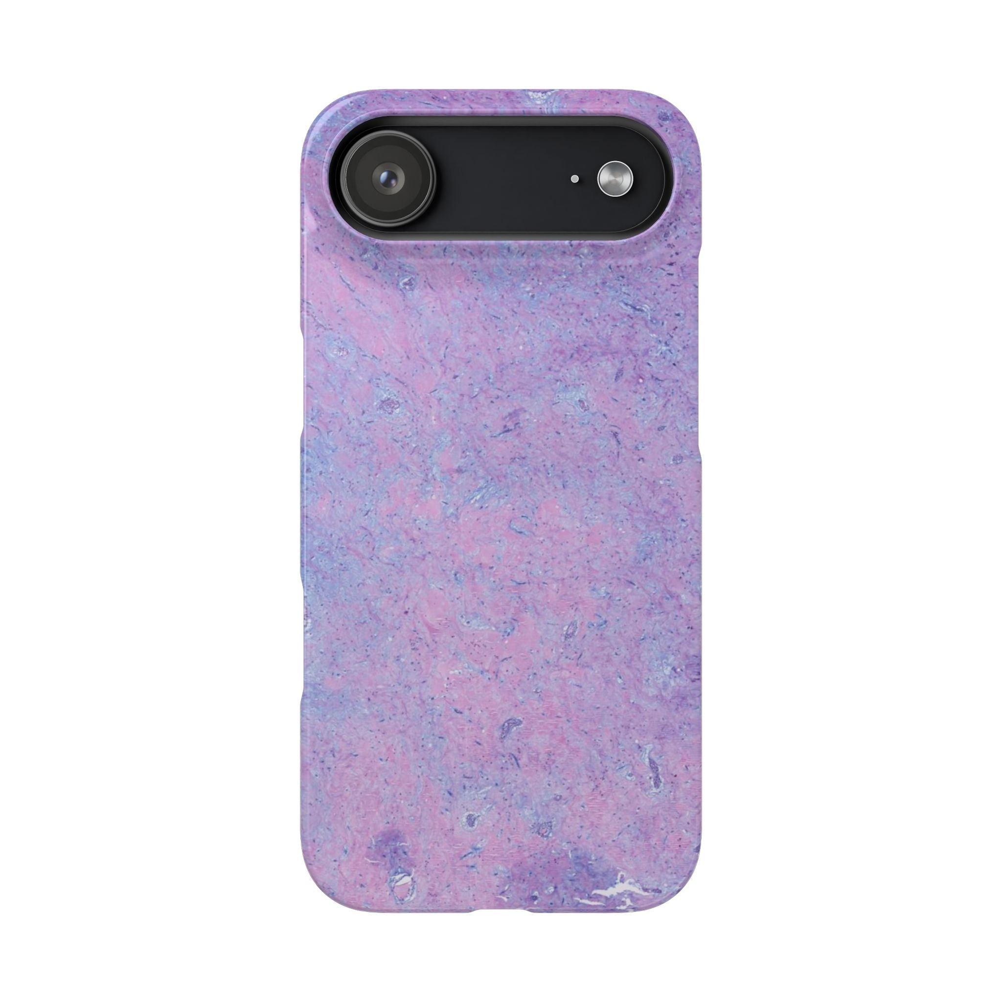 Slim Case Arterielles Myxom
