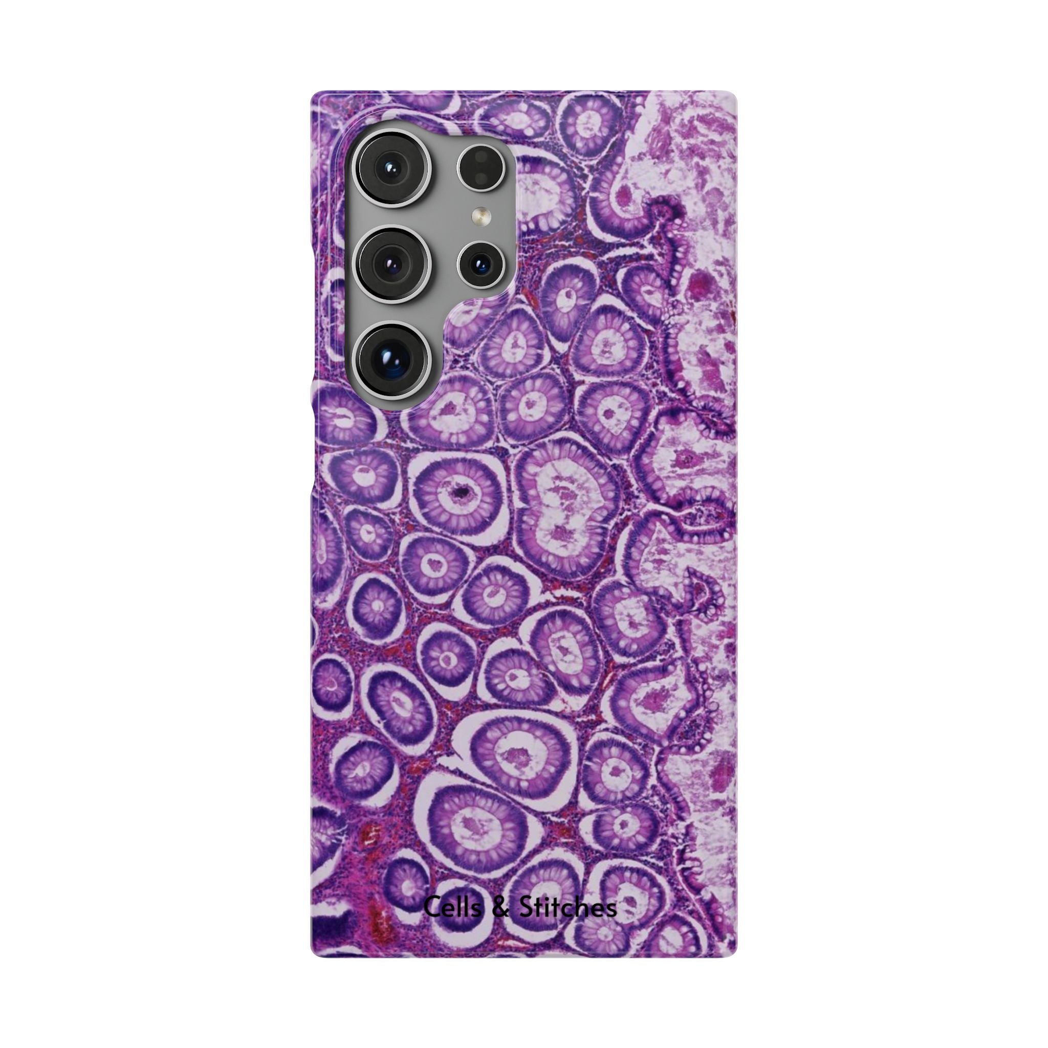 Slim Case Peutz-Jeghers Polyp
