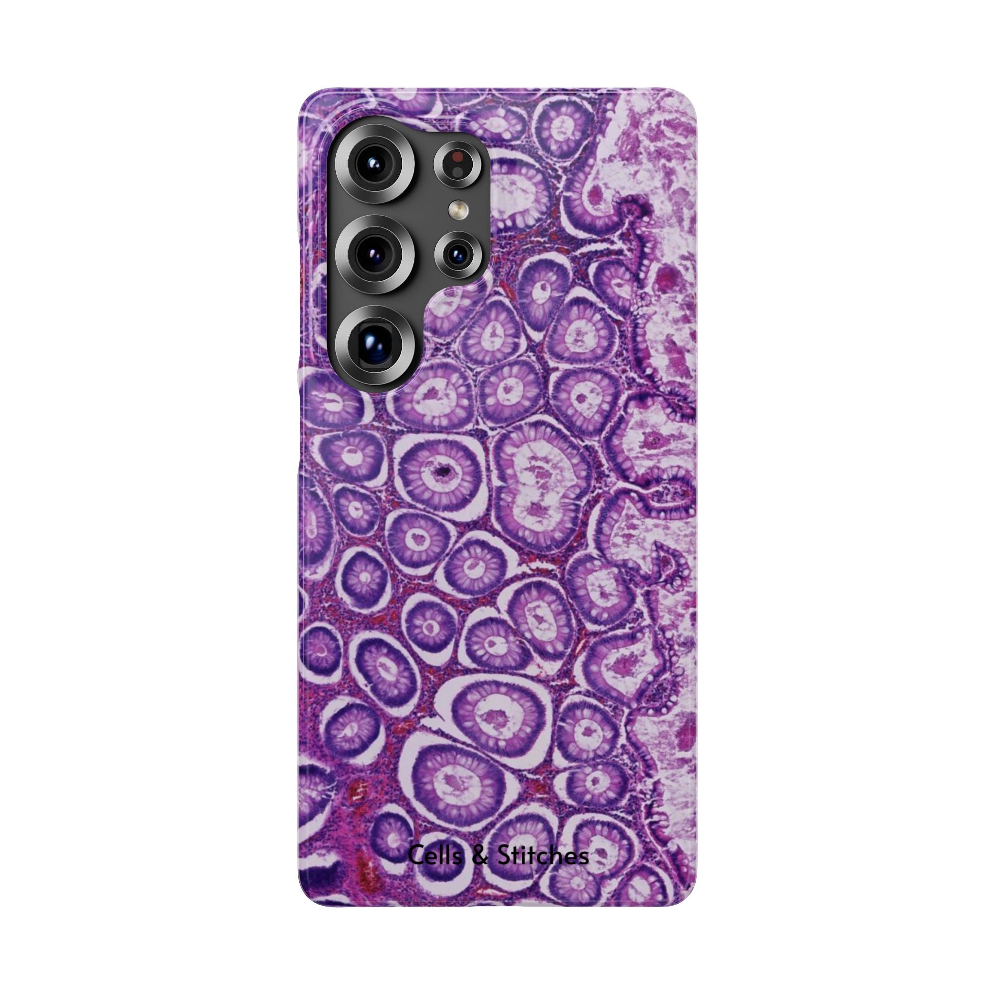 Slim Case Peutz-Jeghers Polyp