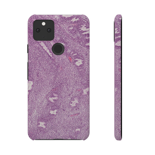 Slim Case Endometrium