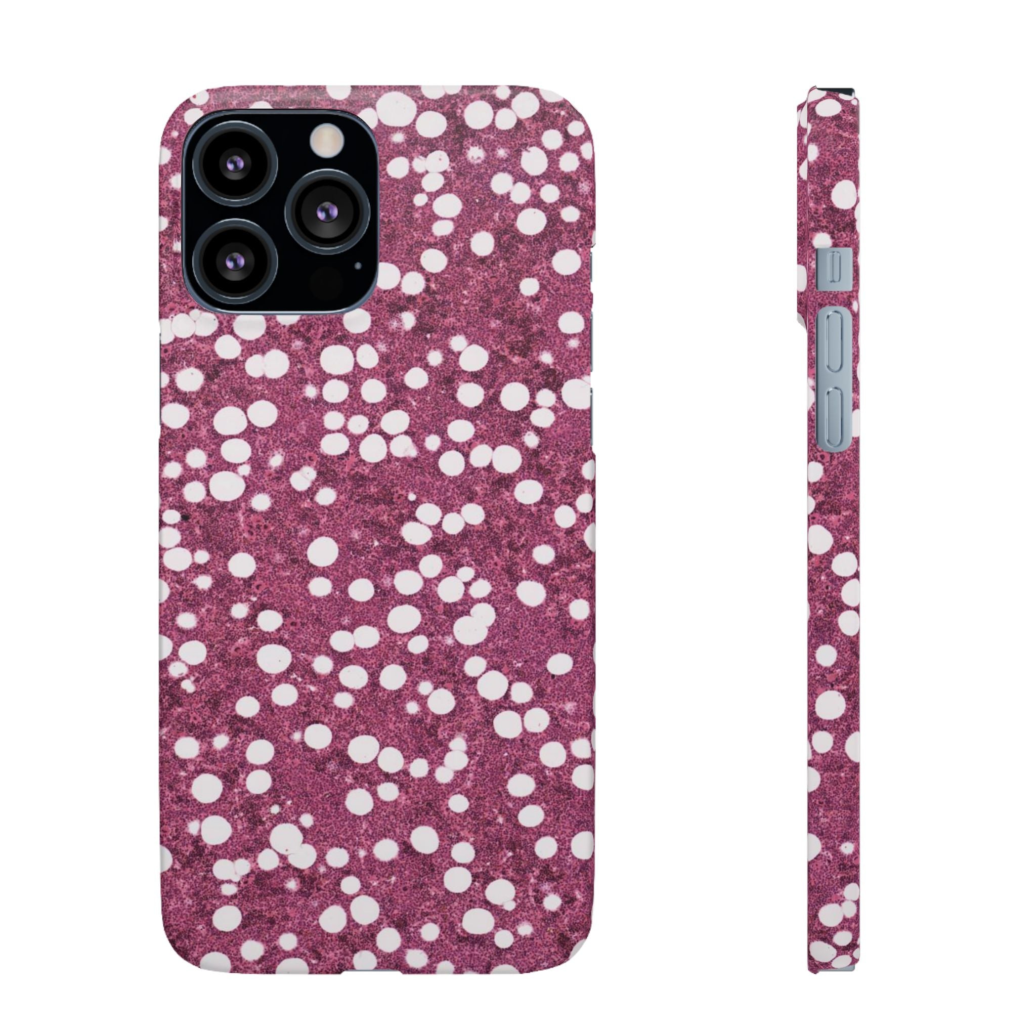 Slim Case Myelolipom