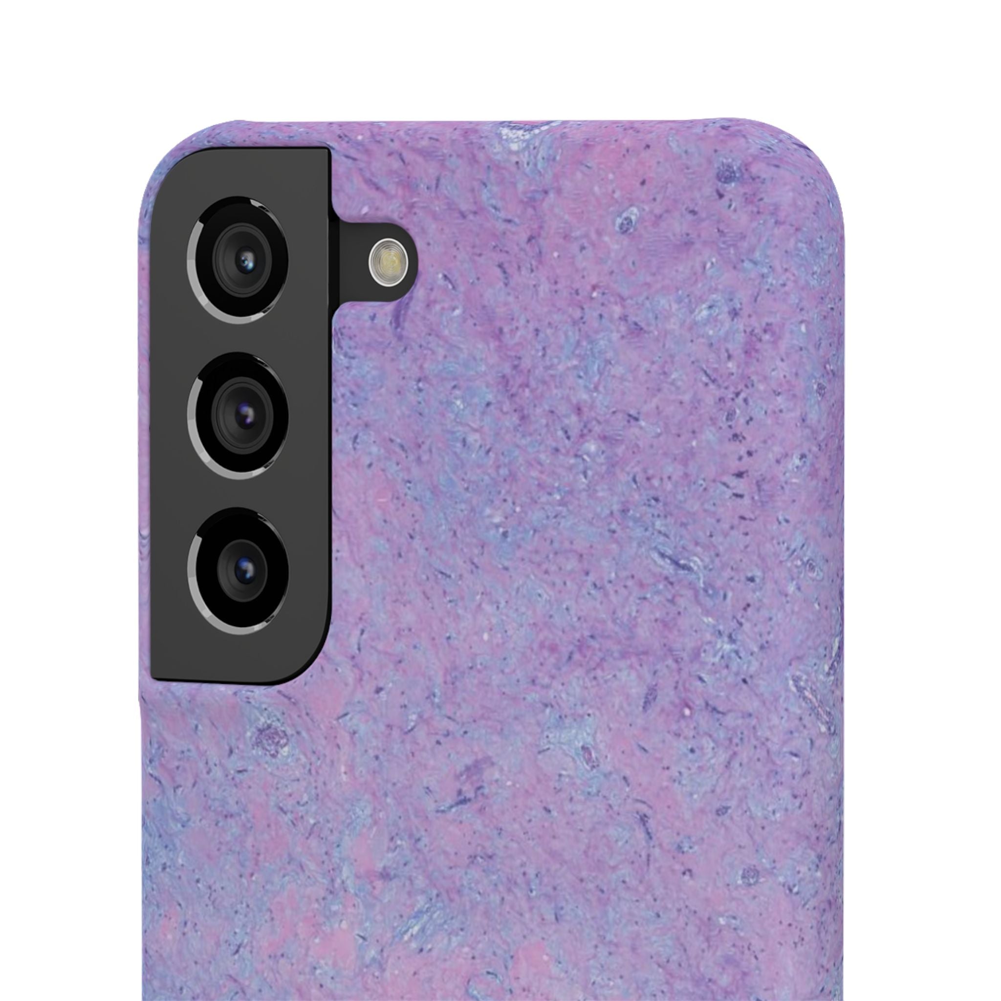 Slim Case Arterielles Myxom