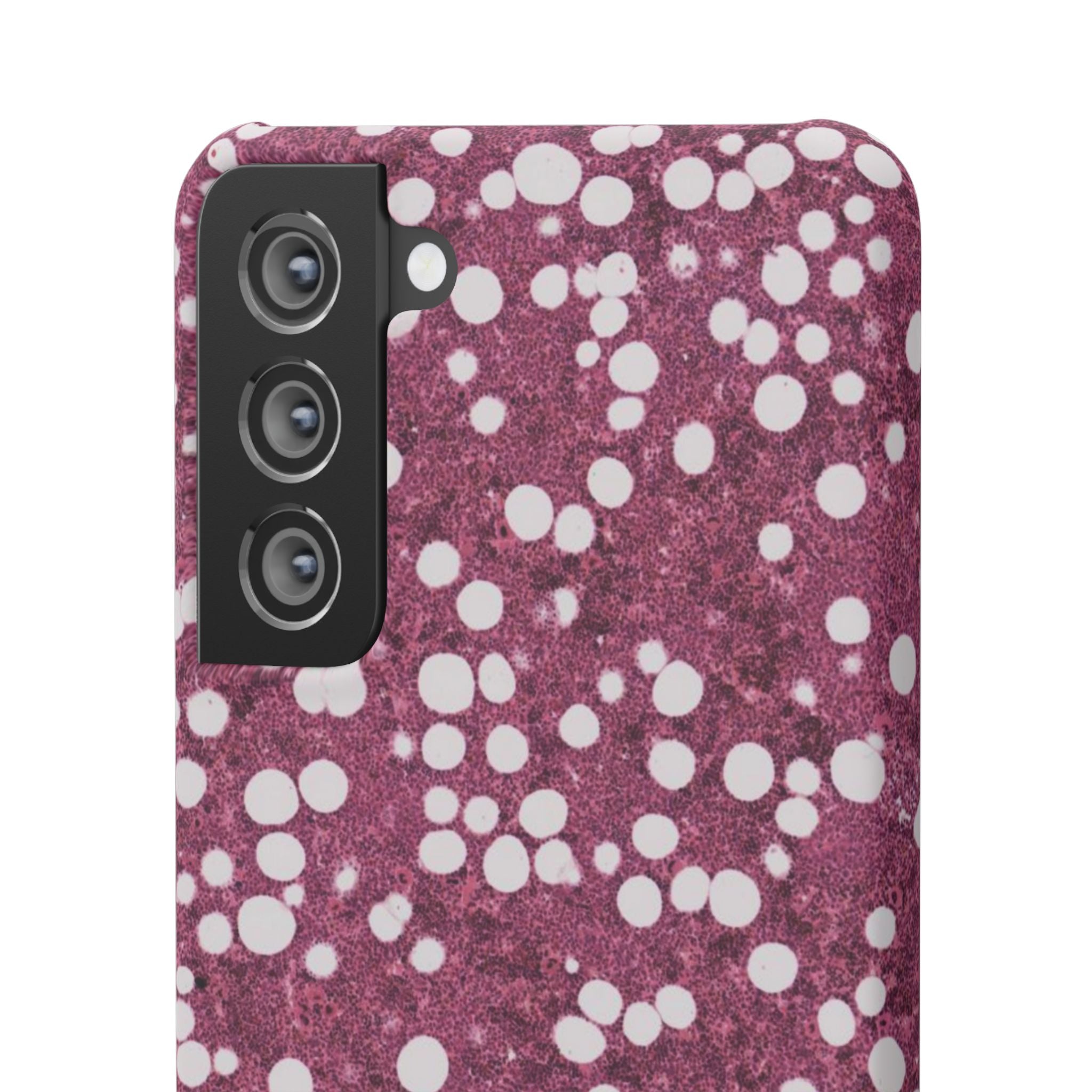 Slim Case Myelolipom