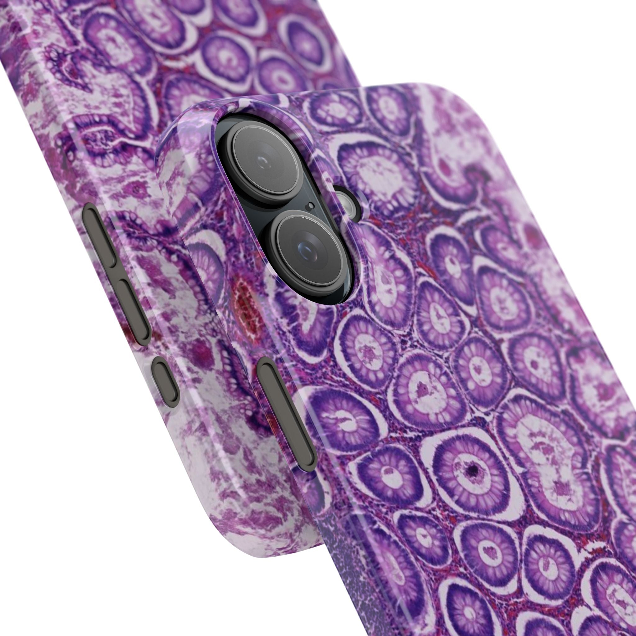 Slim Case Peutz-Jeghers Polyp