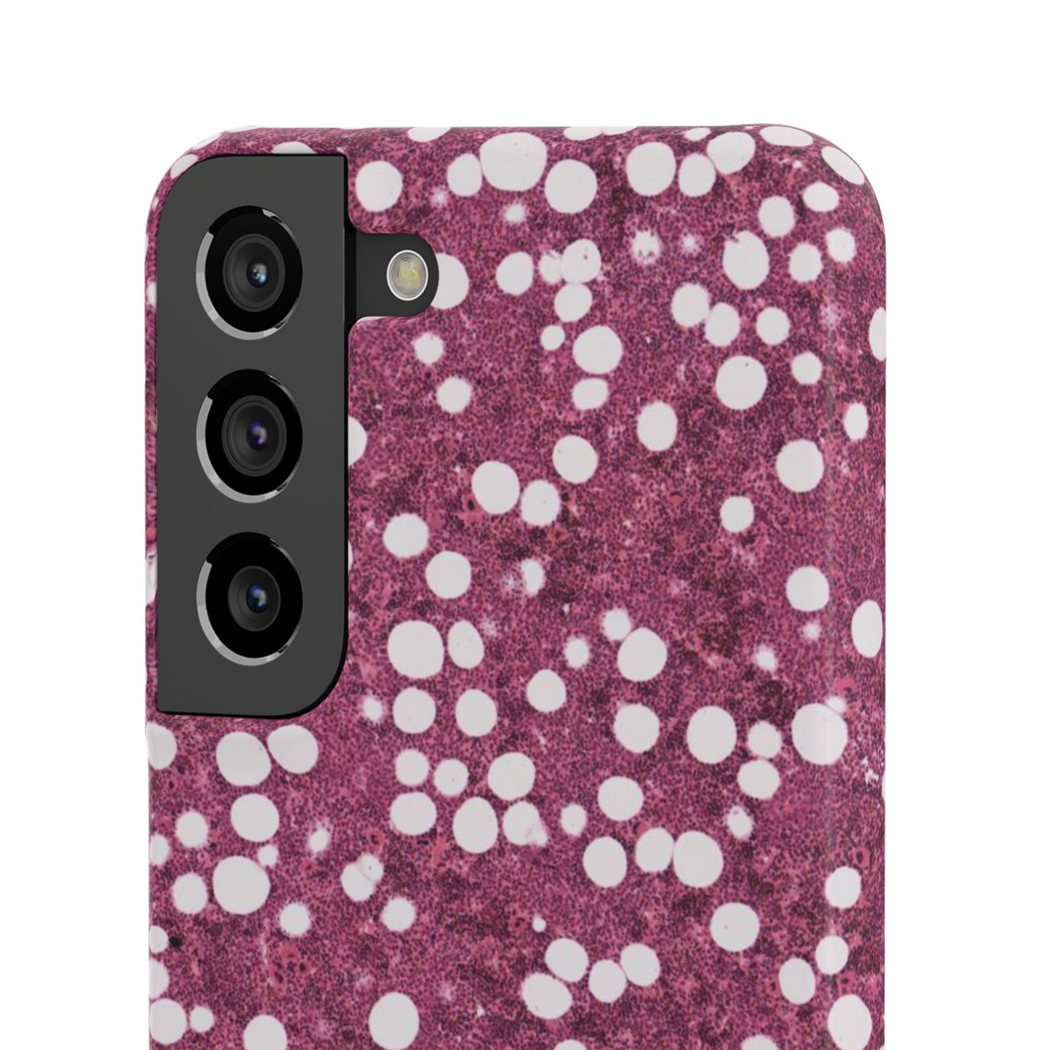 Slim Case Myelolipom