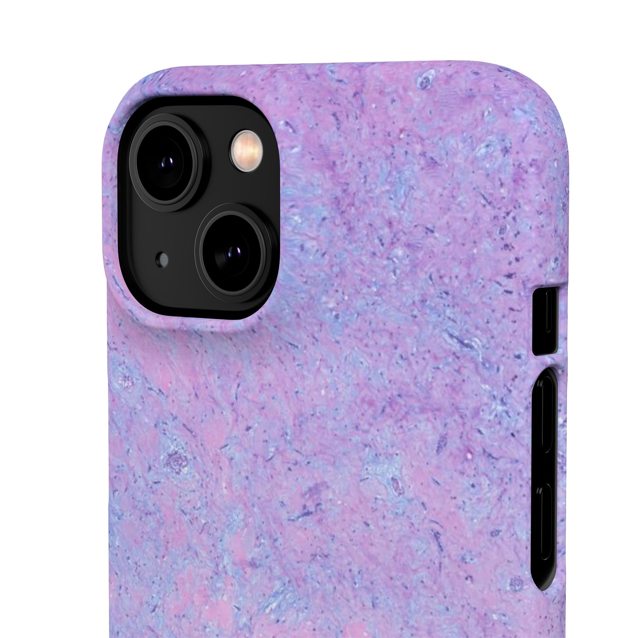 Slim Case Arterielles Myxom