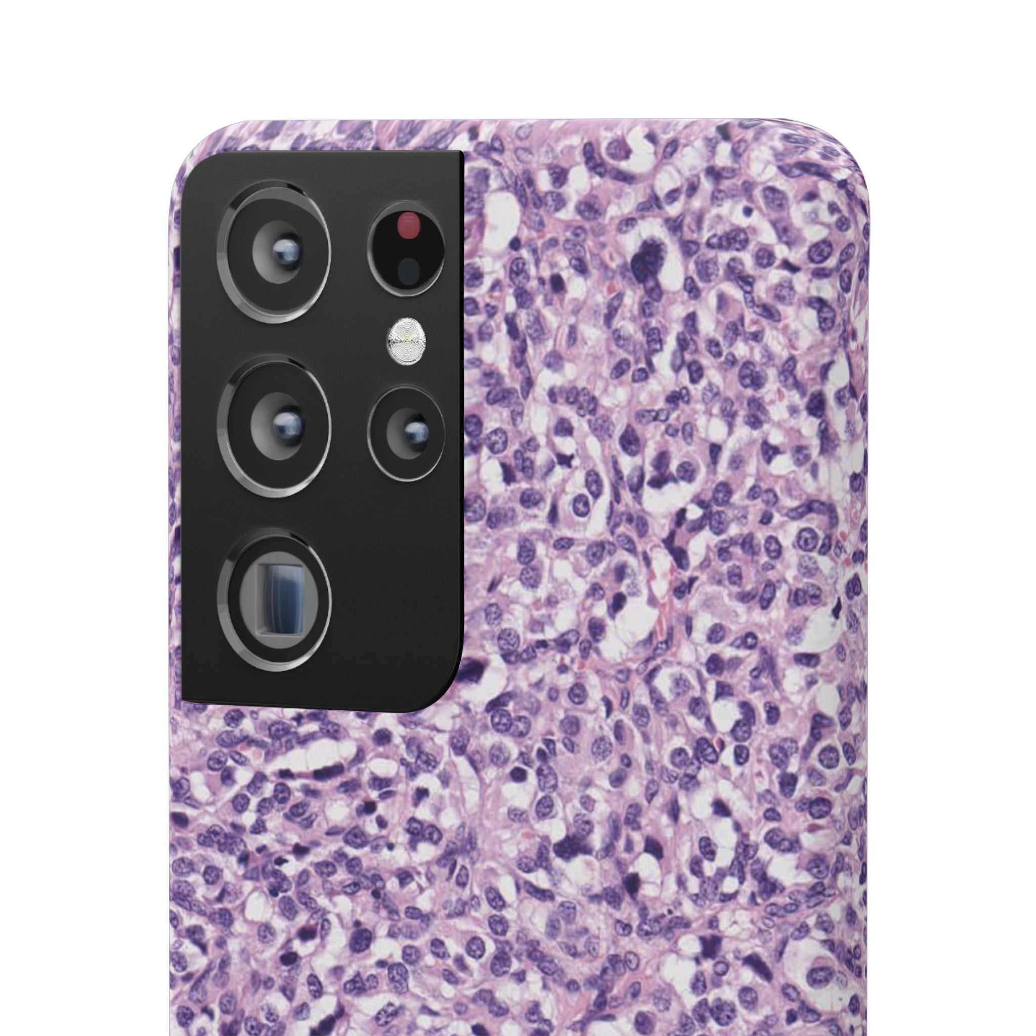 Slim Case Paraganglion