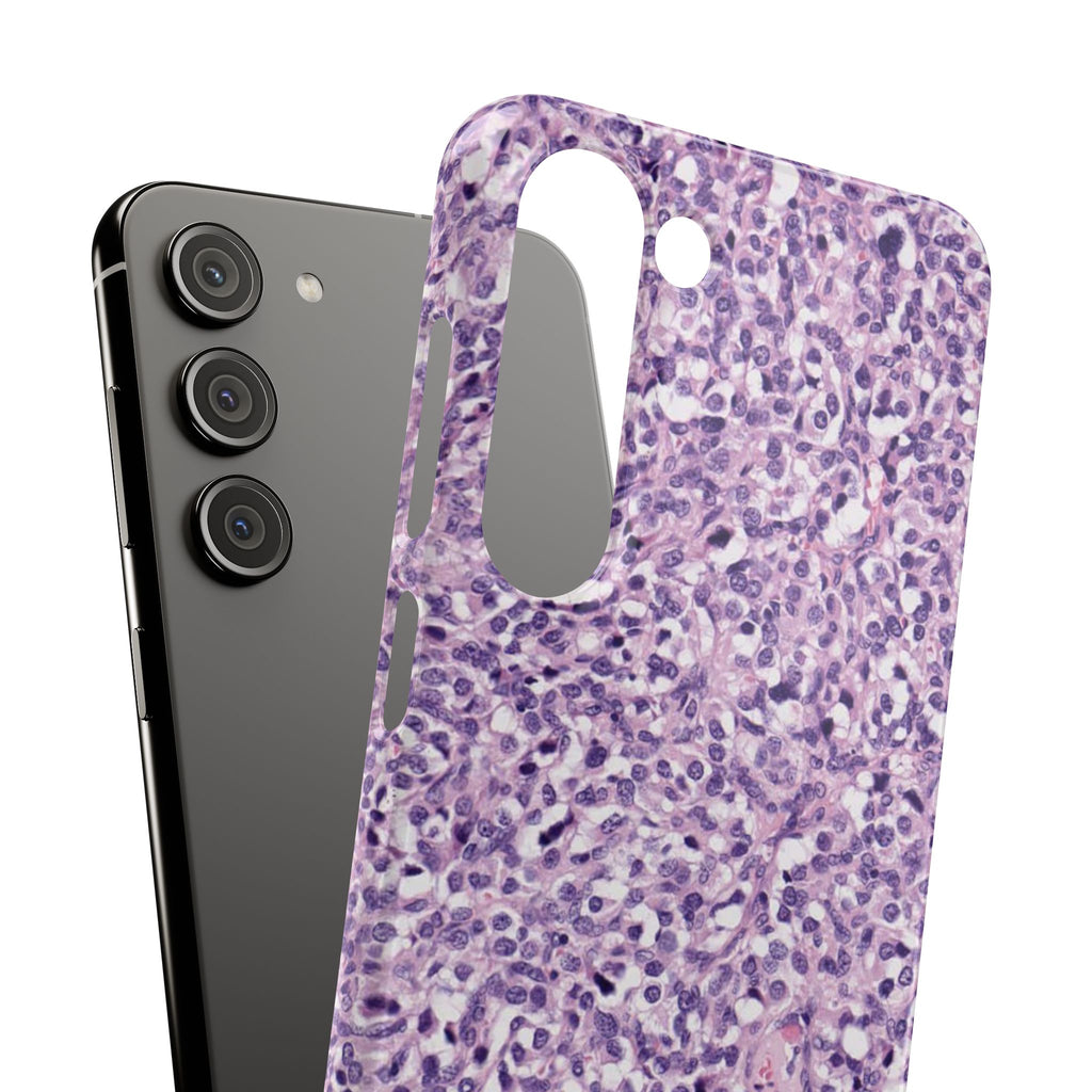 Slim Case Paraganglion