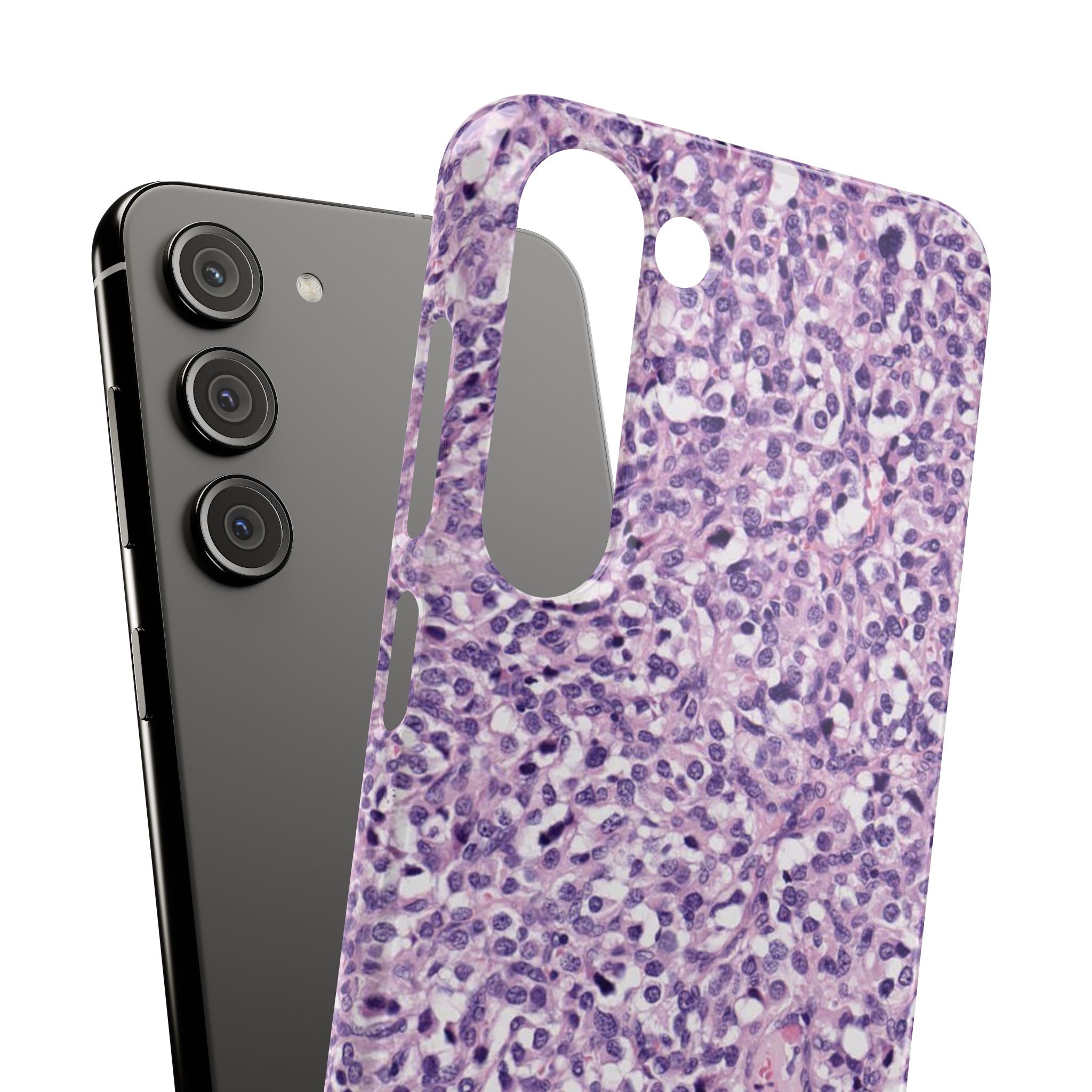 Slim Case Paraganglion